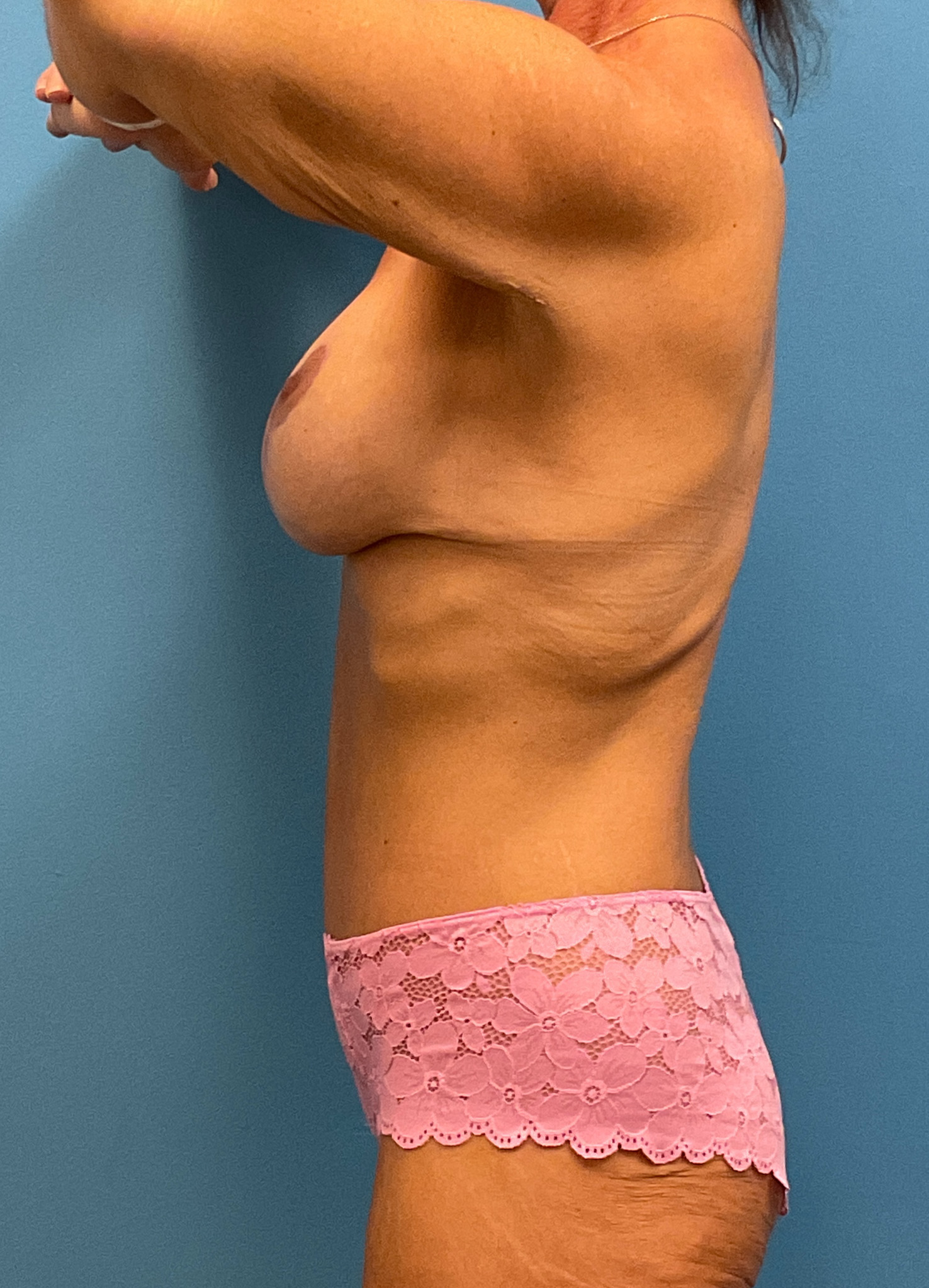 Abdominoplasty-Case--7009 | After Tummy Tuck 3