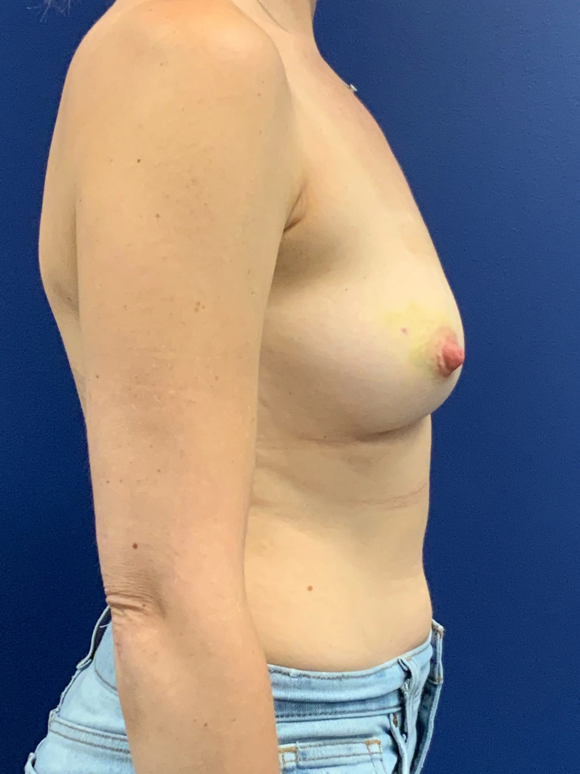 Breast-Reconstruction-Case--7867 | Before Breast Reconstruction 2