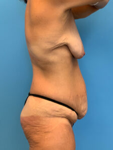 Abdominoplasty-Case--7038 | Before Dr. Frank Albino 2