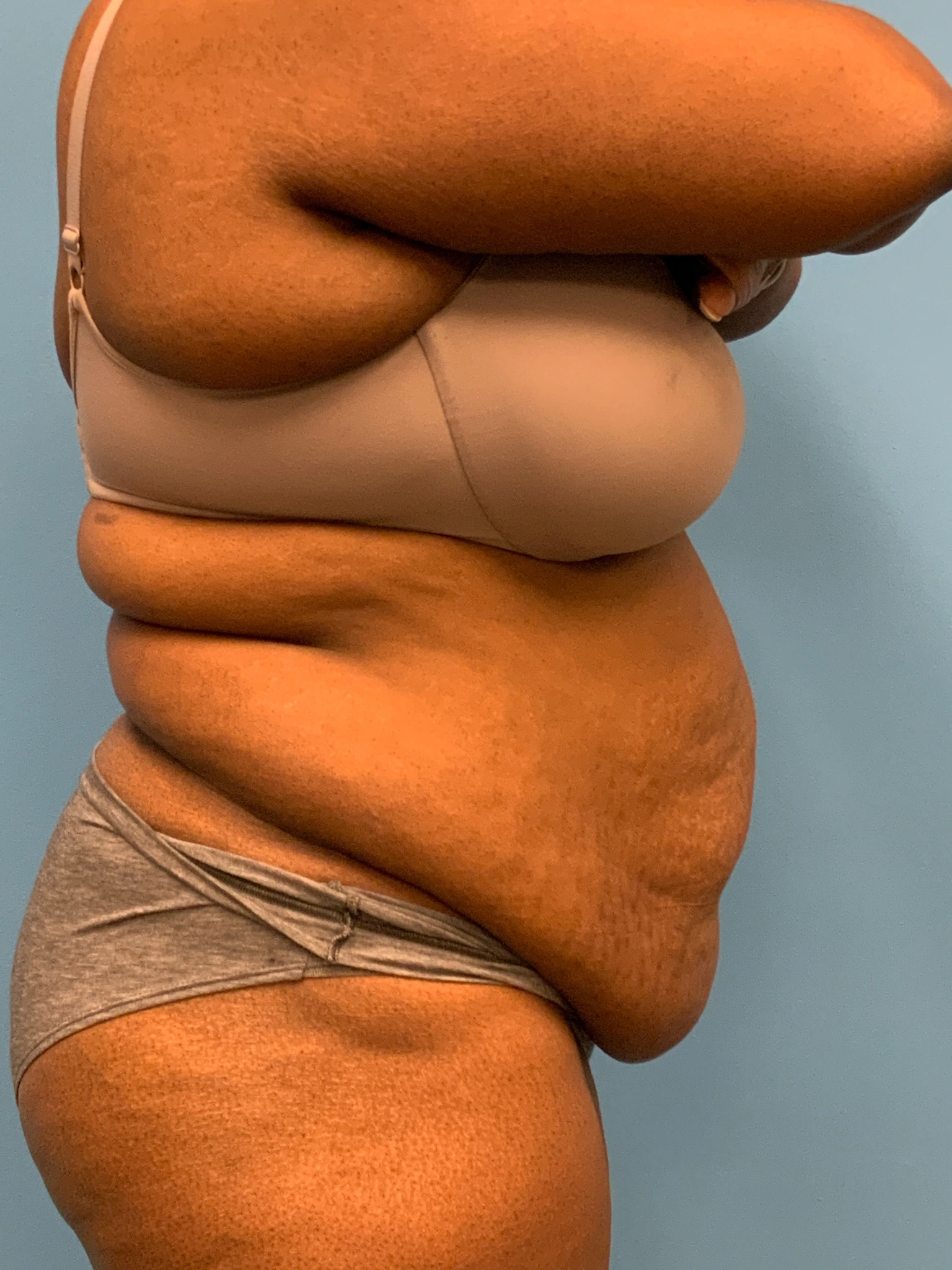 Abdominoplasty-Case--5907 | Before Tummy Tuck 3