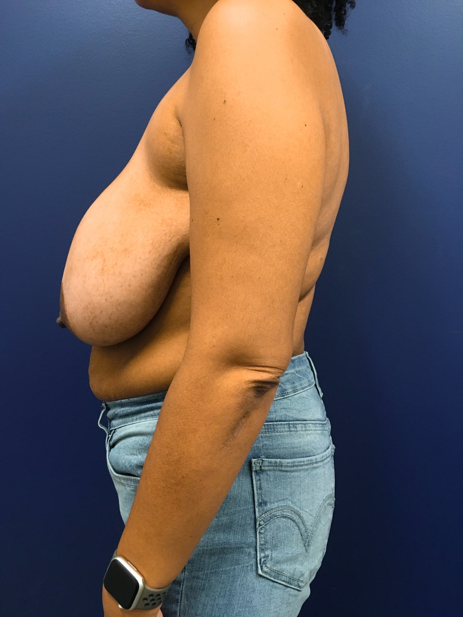 Breast-Reduction-Case--4484 | Before Breast Reduction 3