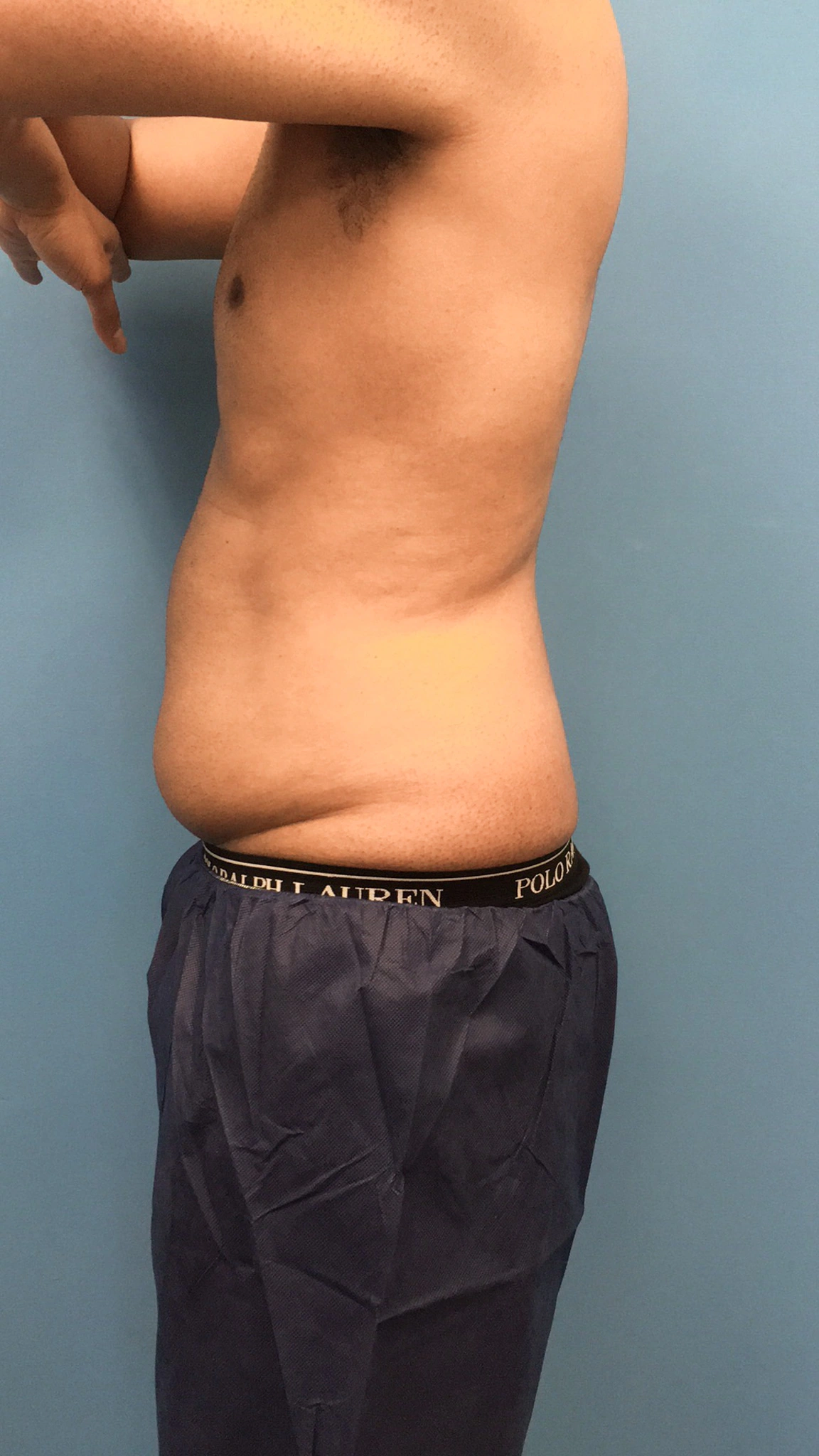 Lipo-360-Case--4979 | Before Liposuction 3