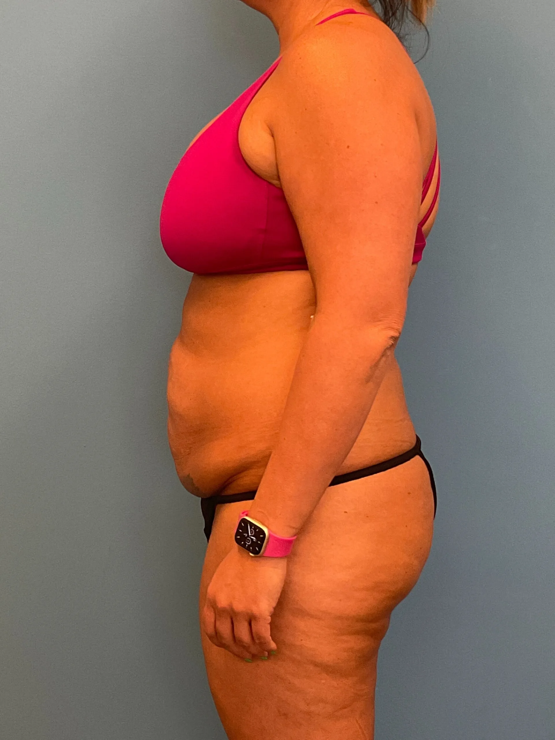 Abdominoplasty-Case--3117 | Before Tummy Tuck 3