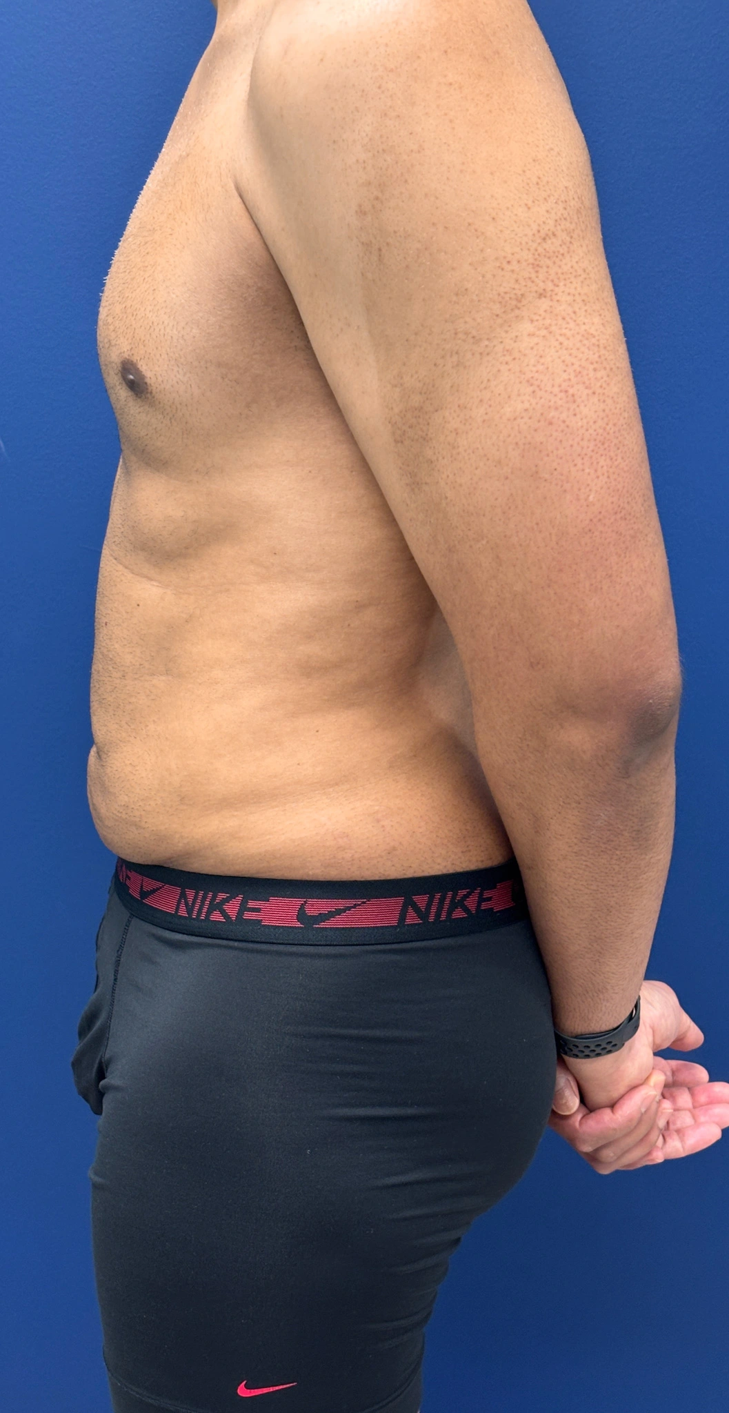 Lipo-360-Case--4979 | After Liposuction 3