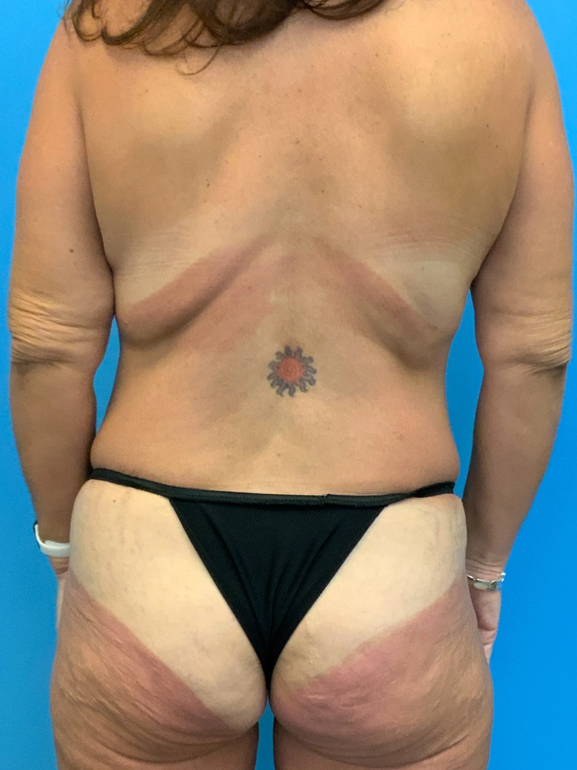 Abdominoplasty-Case--7009 | Before Tummy Tuck 6