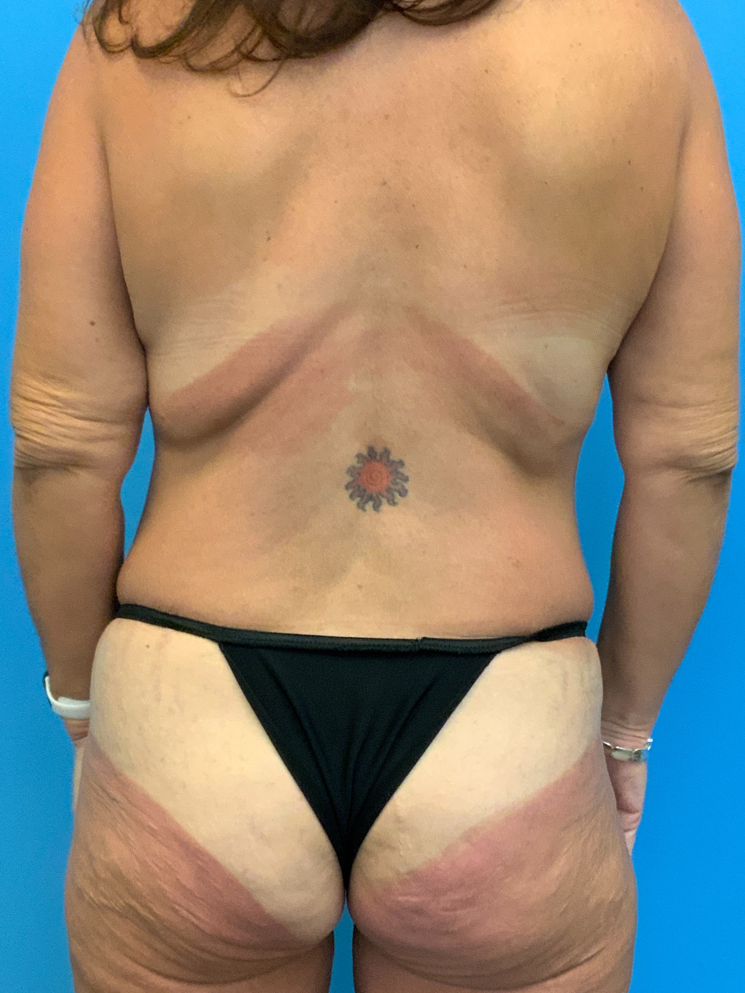 Abdominoplasty-Case--7038 | Before Tummy Tuck 6