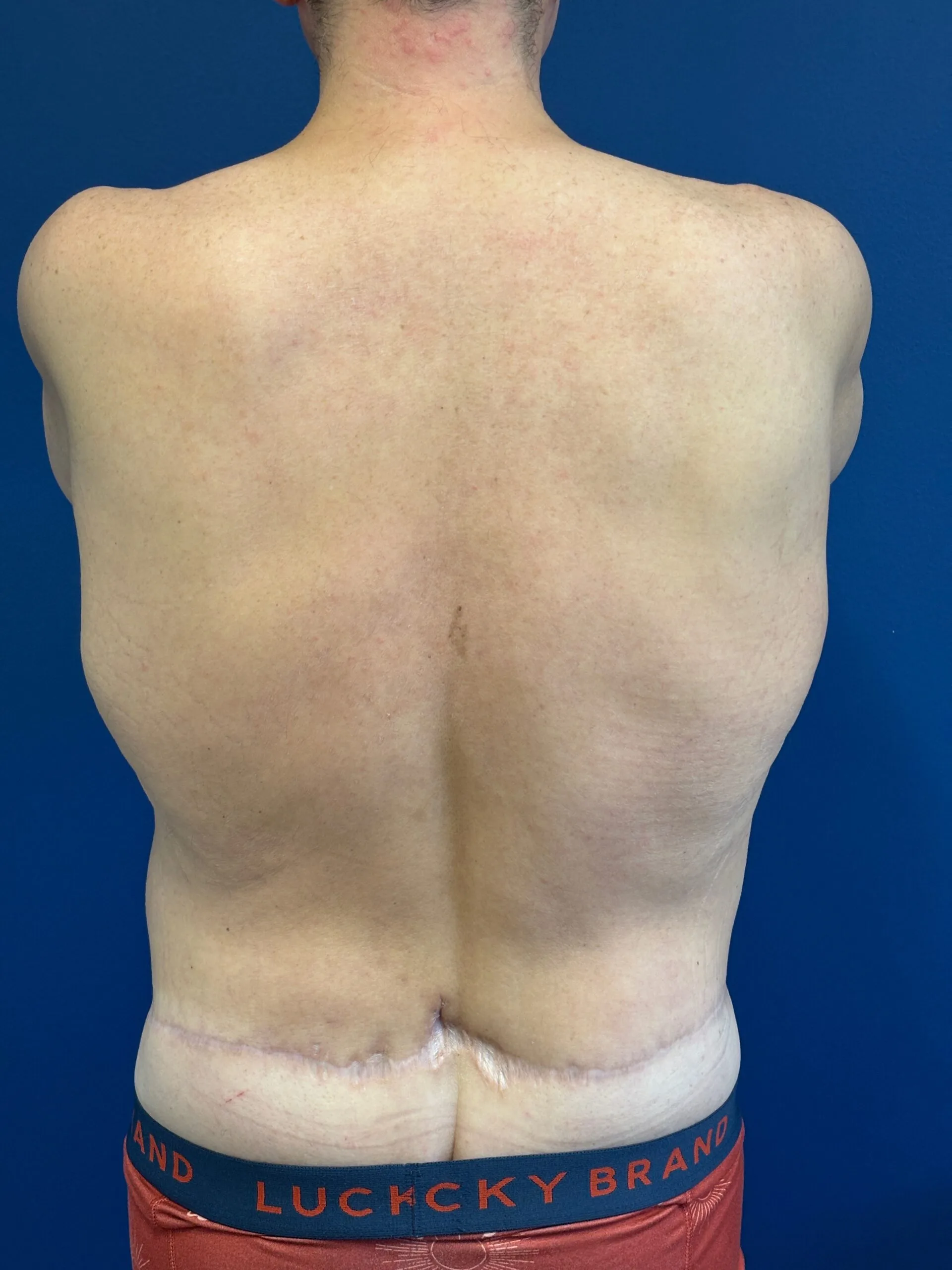 Abdominoplasty-Case--2524 | After Tummy Tuck 3