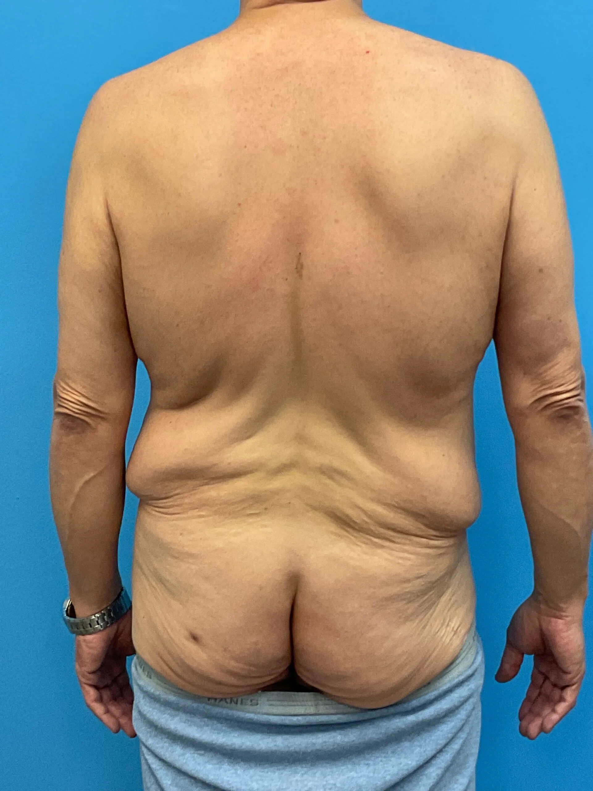 Abdominoplasty-Case--2524 | Before Tummy Tuck 3