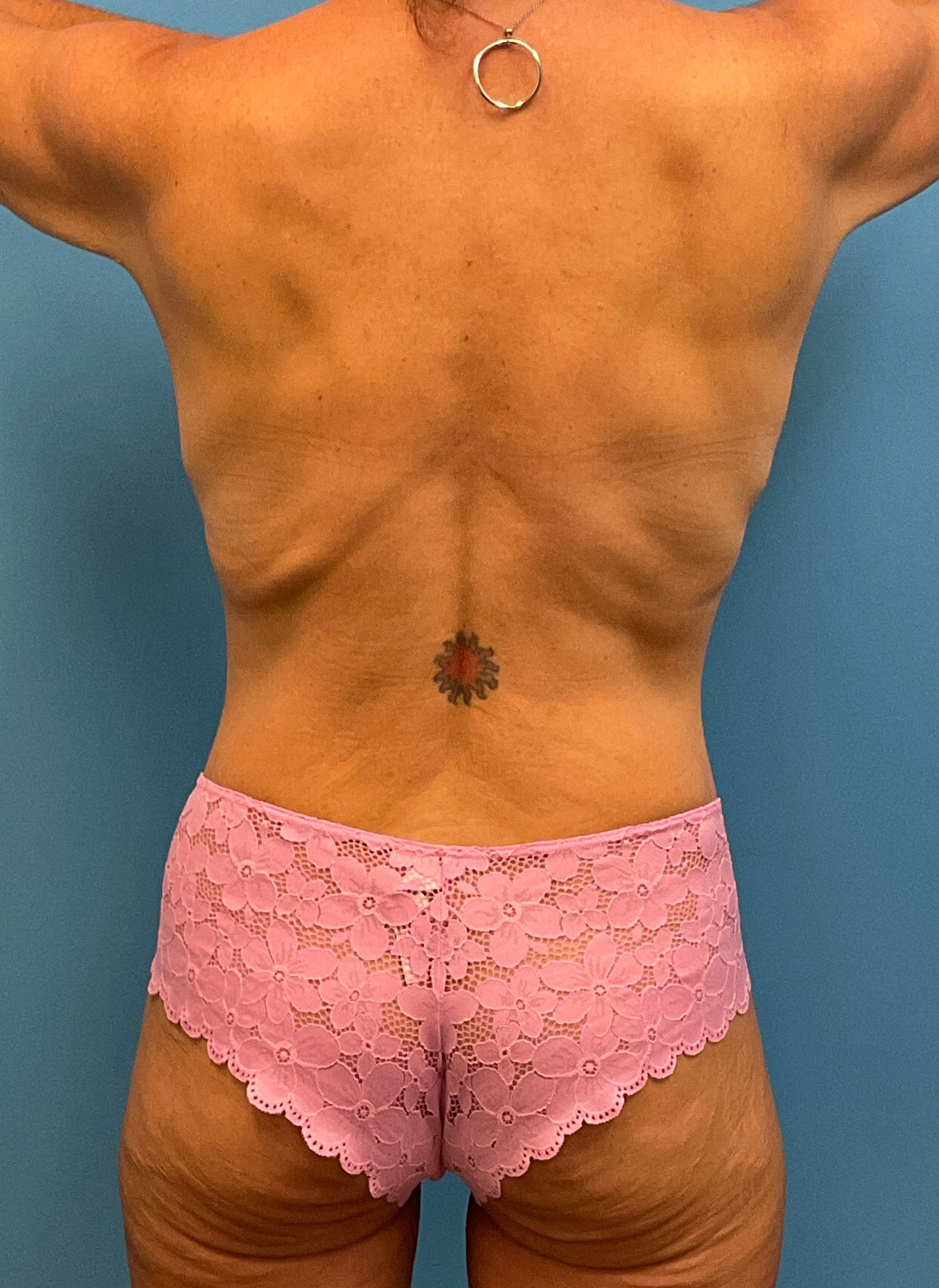 Abdominoplasty-Case--7009 | After Tummy Tuck 6