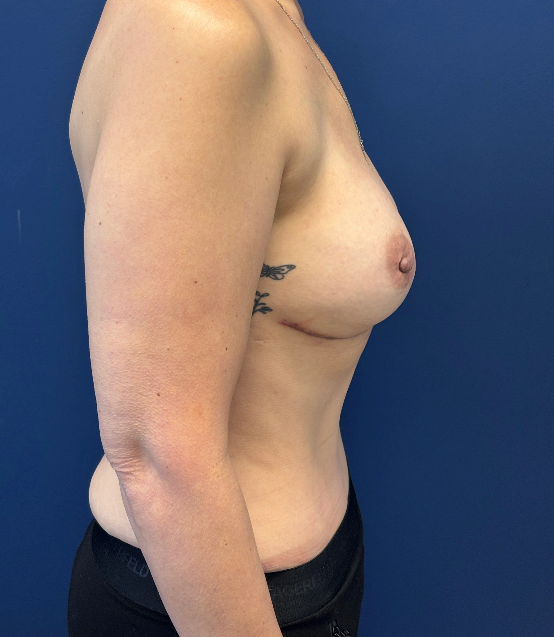 Abdominoplasty-Case--4660 | After Tummy Tuck 2