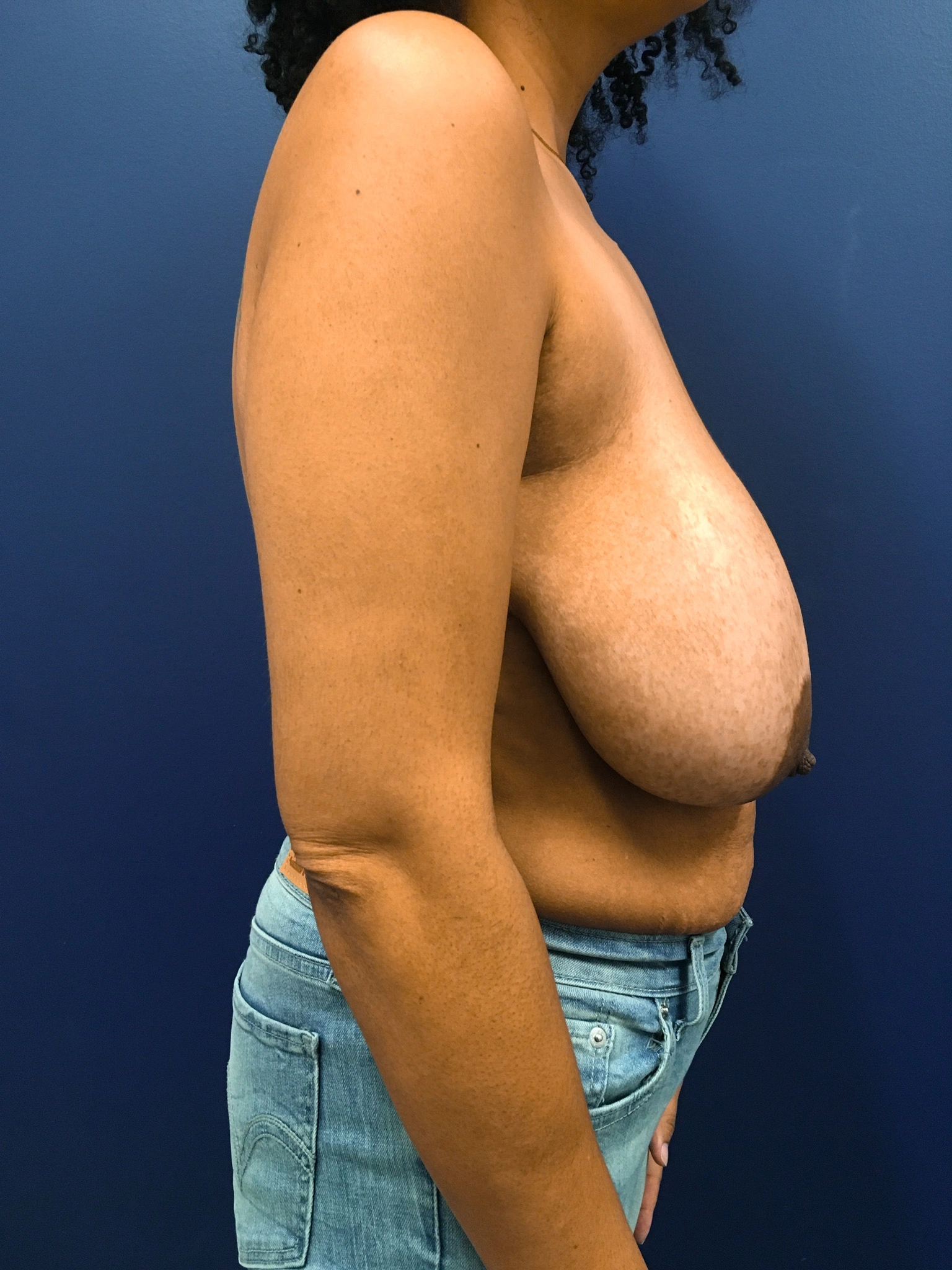 Breast-Reduction-Case--4484 | Before Breast Reduction 2