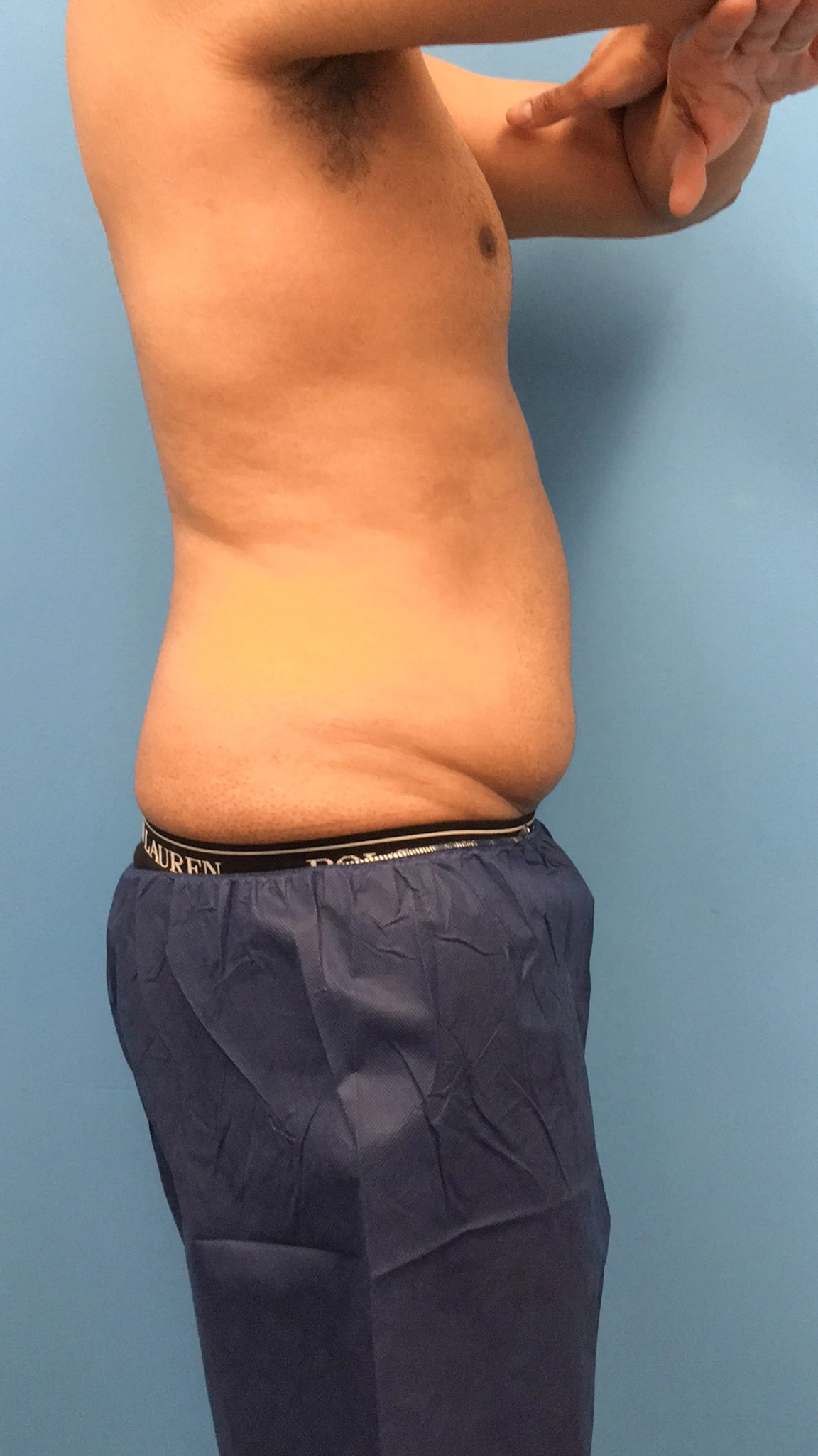 Lipo-360-Case--4979 | Before Liposuction 2