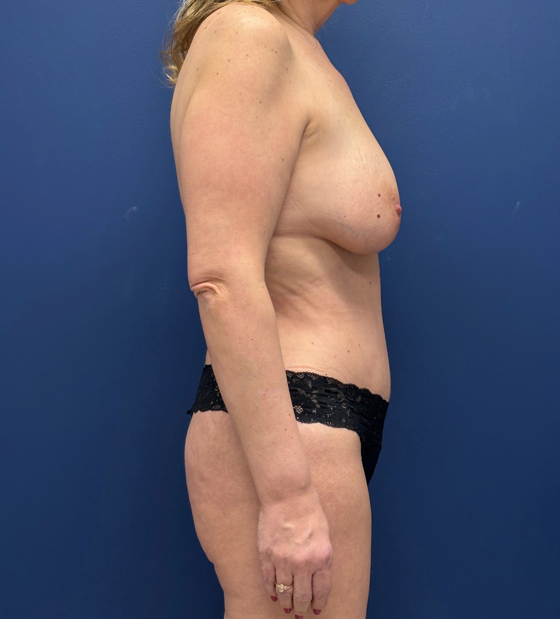 Abdominoplasty-Case--6263 | After Tummy Tuck 3