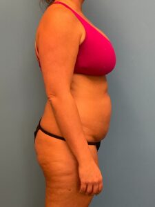 Abdominoplasty-Case--3117 | Before Dr. Frank Albino 2