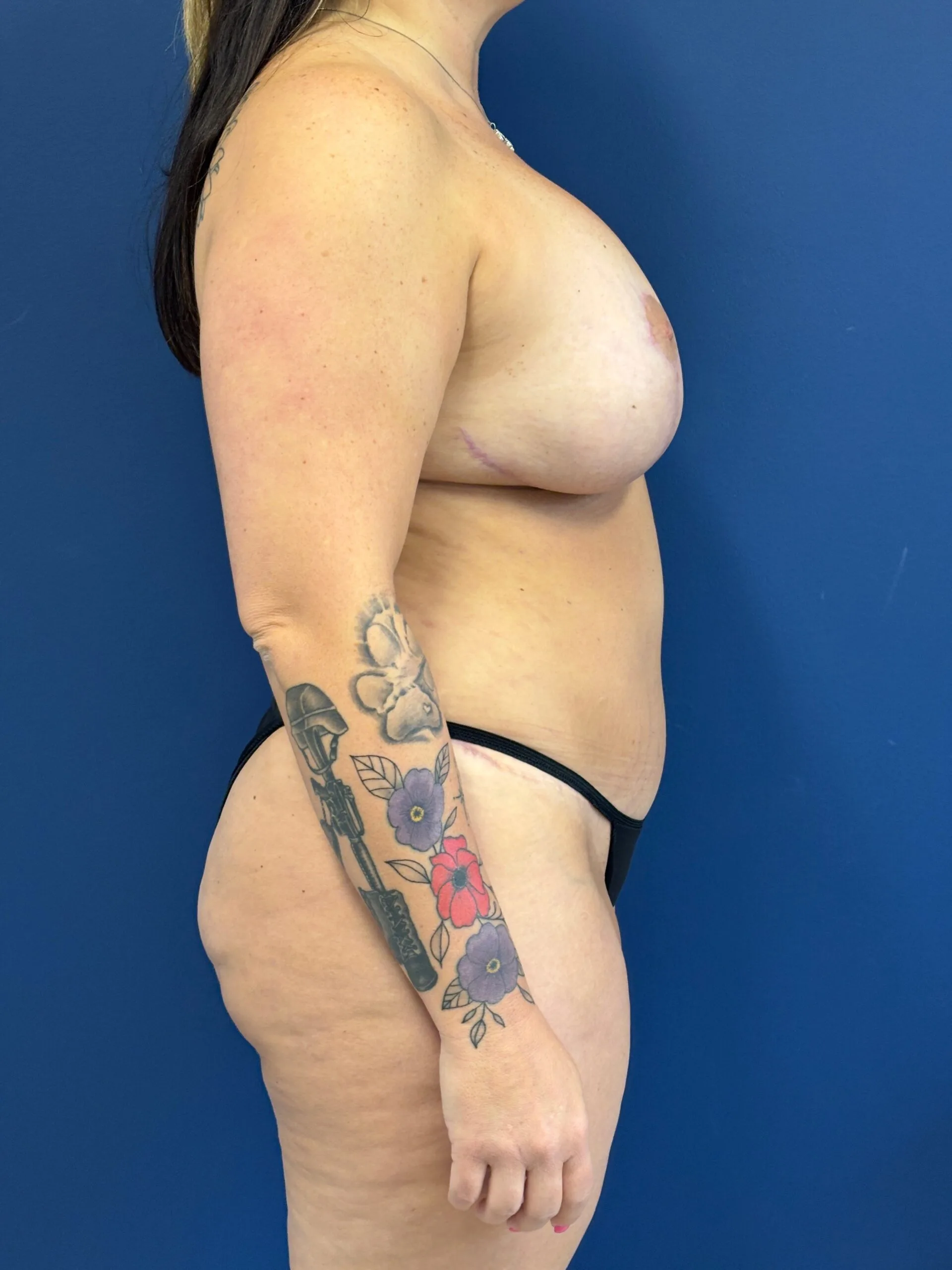 Abdominoplasty-Case--3117 | After Tummy Tuck 2