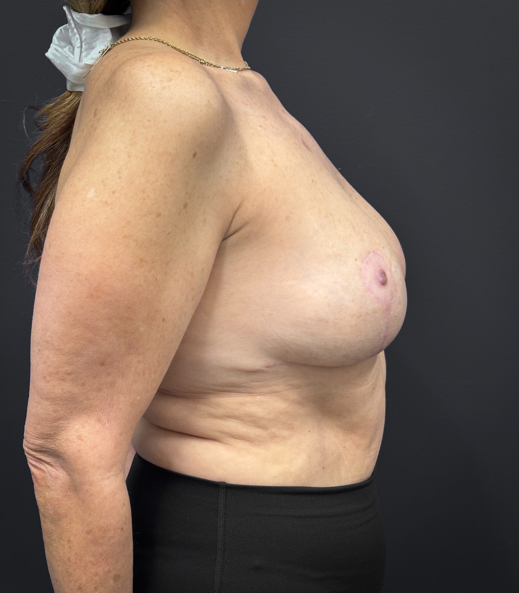 Breast-Reduction-Case--2538 | After Breast Reduction 3