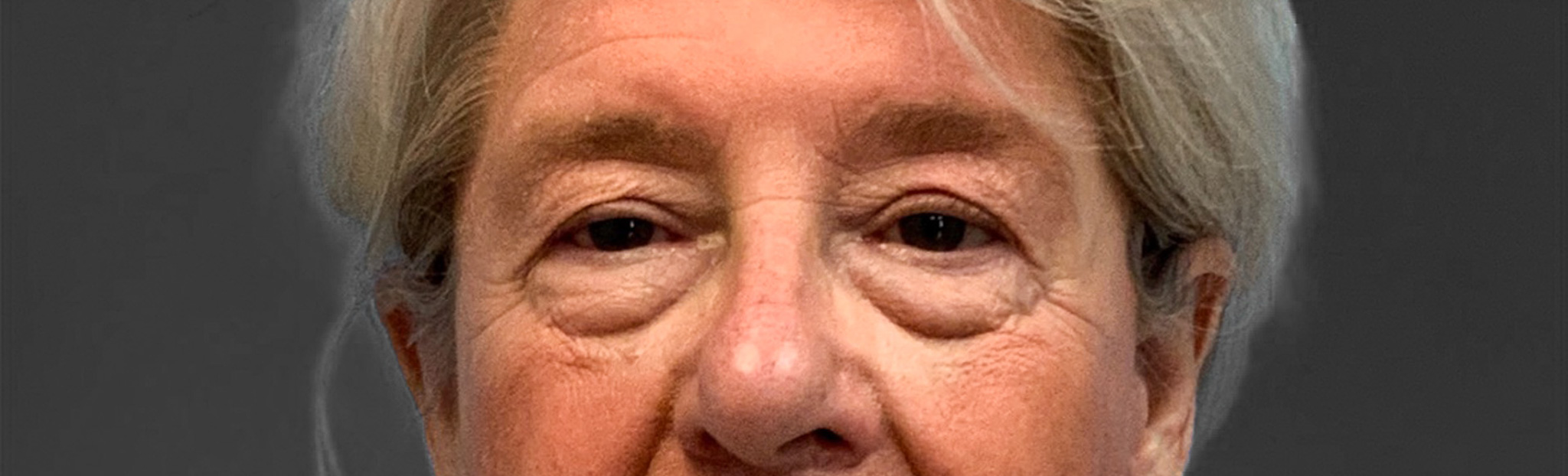 Blepharoplasty-Case--3336 | Before Eyelid Surgery 1