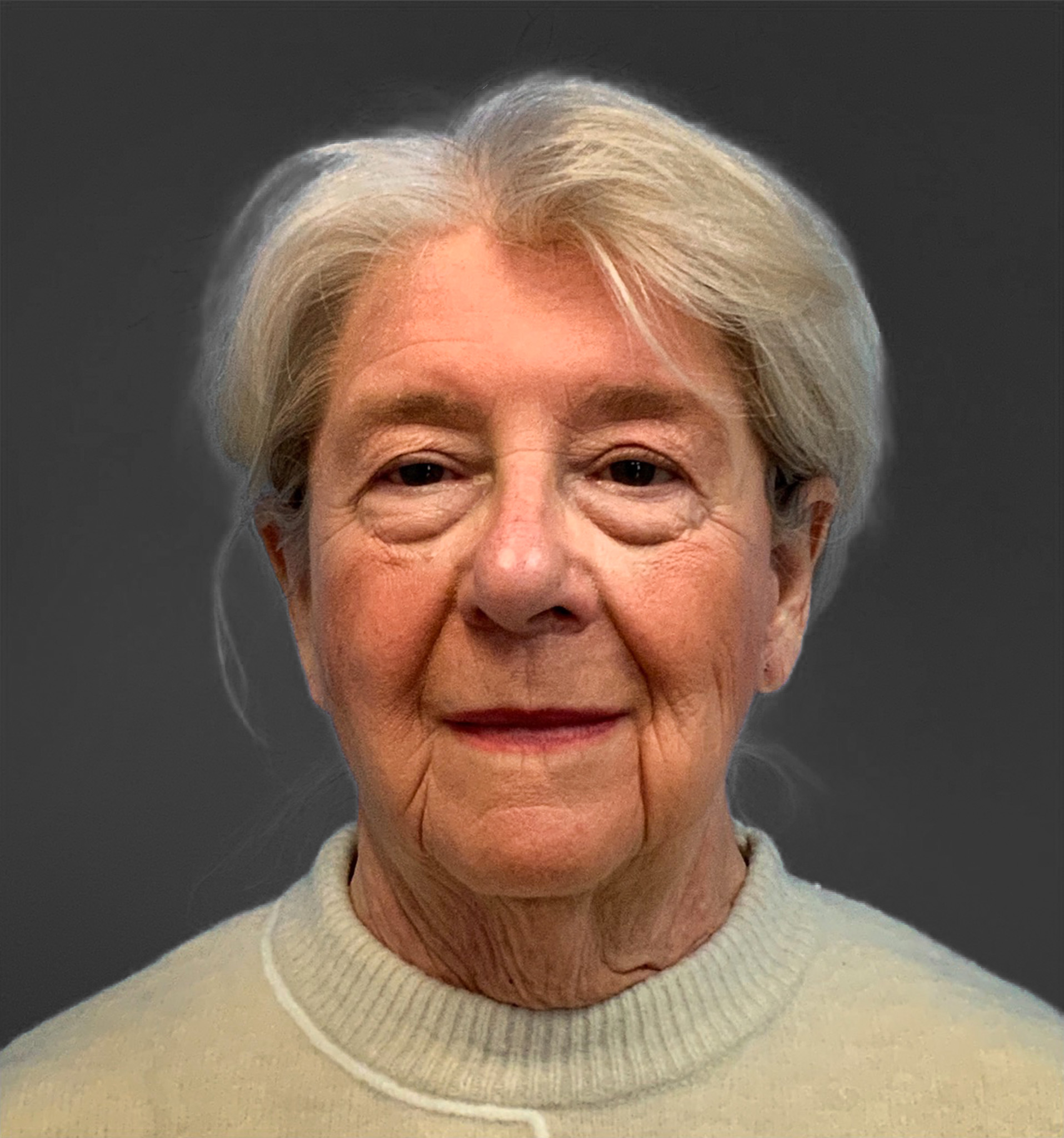 Blepharoplasty-Case--3336 | Before Eyelid Surgery 5