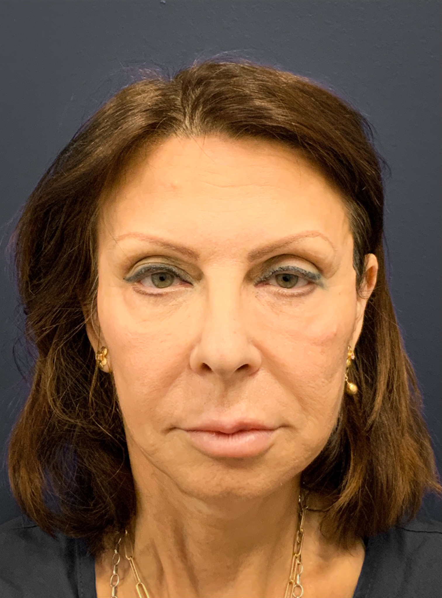 Blepharoplasty-Case--6272 | Before Eyelid Surgery 6