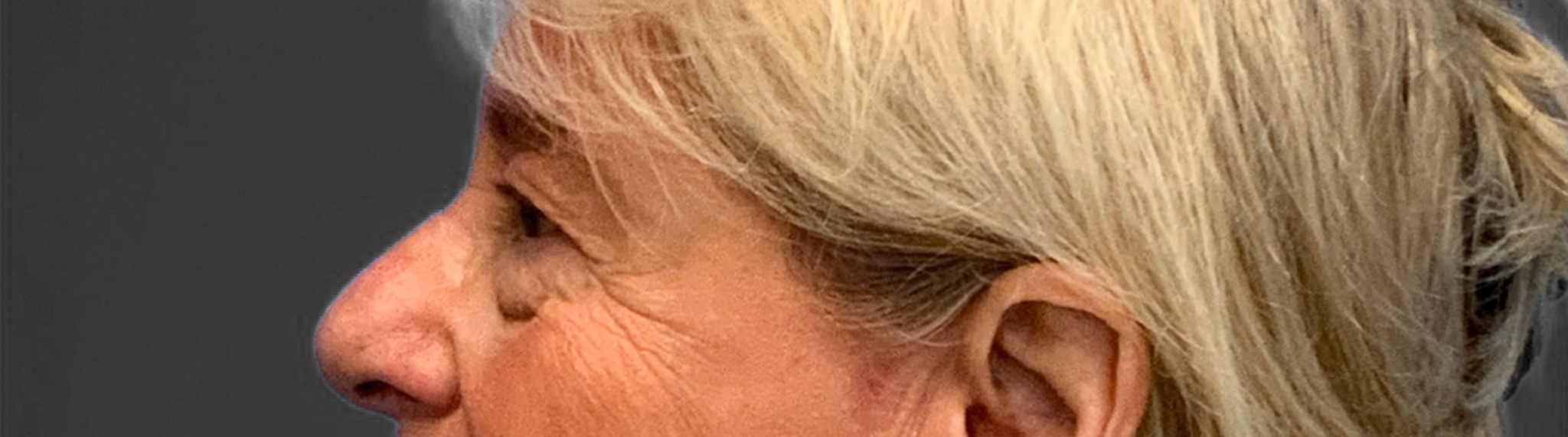 Blepharoplasty-Case--3336 | Before Eyelid Surgery 3