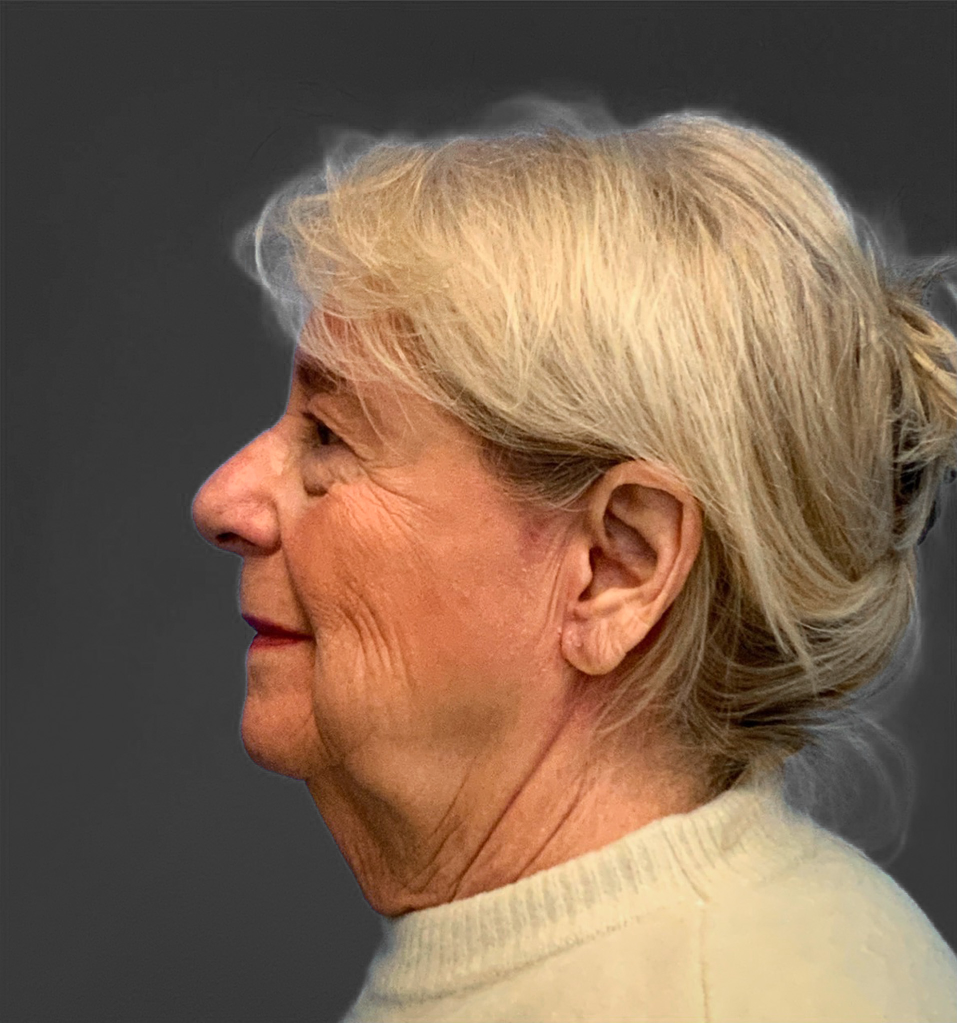 Blepharoplasty-Case--3336 | Before Eyelid Surgery 6