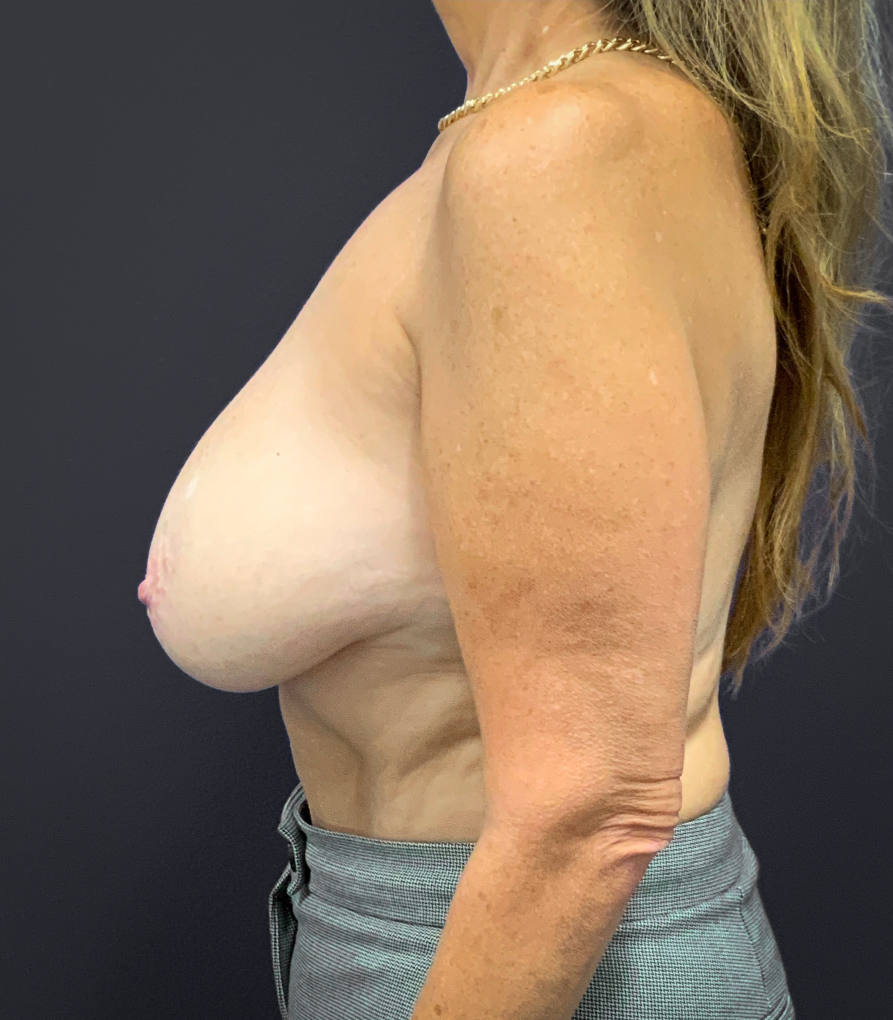 Breast-Reduction-Case--2538 | Before Breast Reduction 2