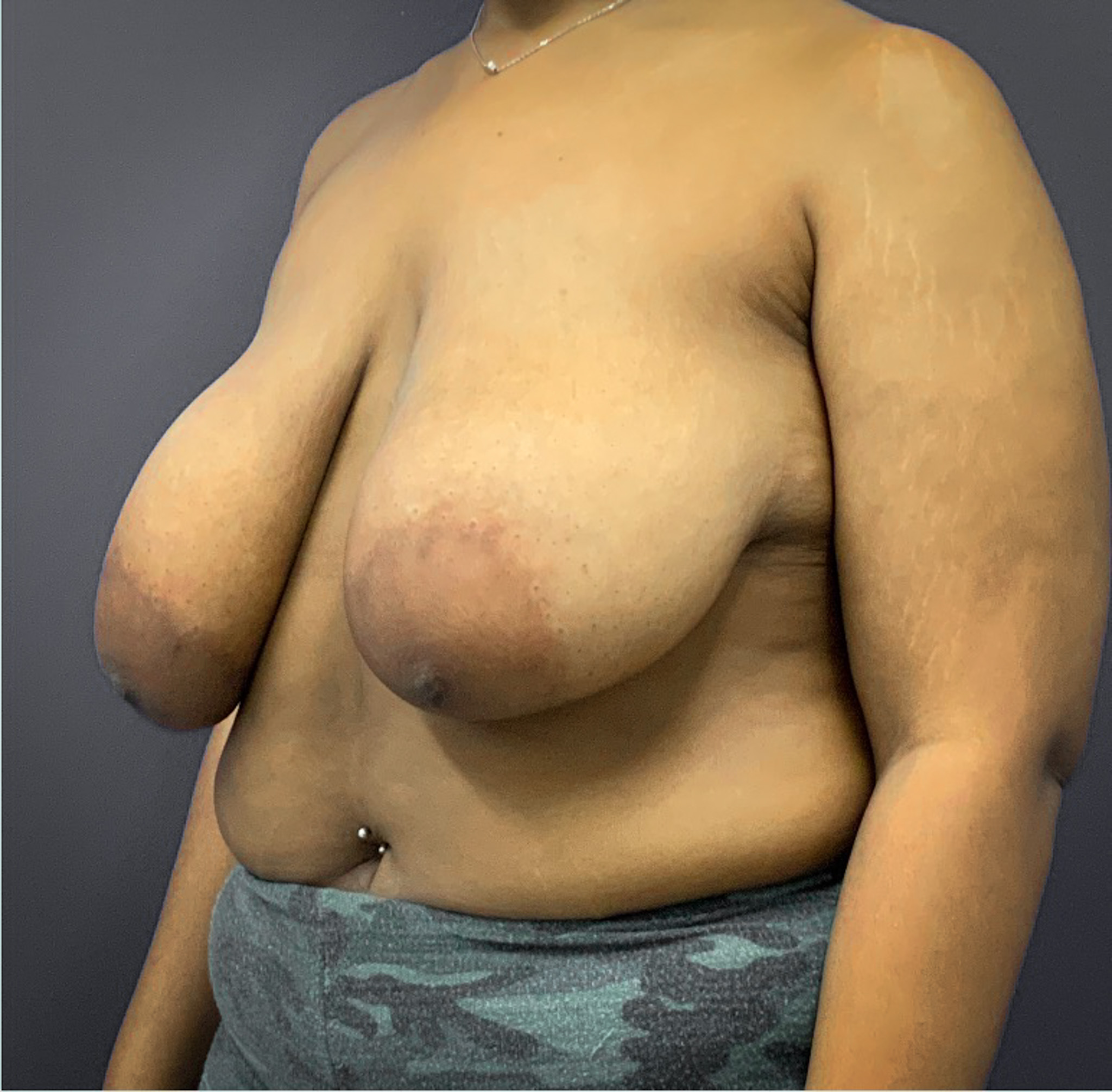 Breast-Reduction-Case--5320 | Before Breast Reduction 4