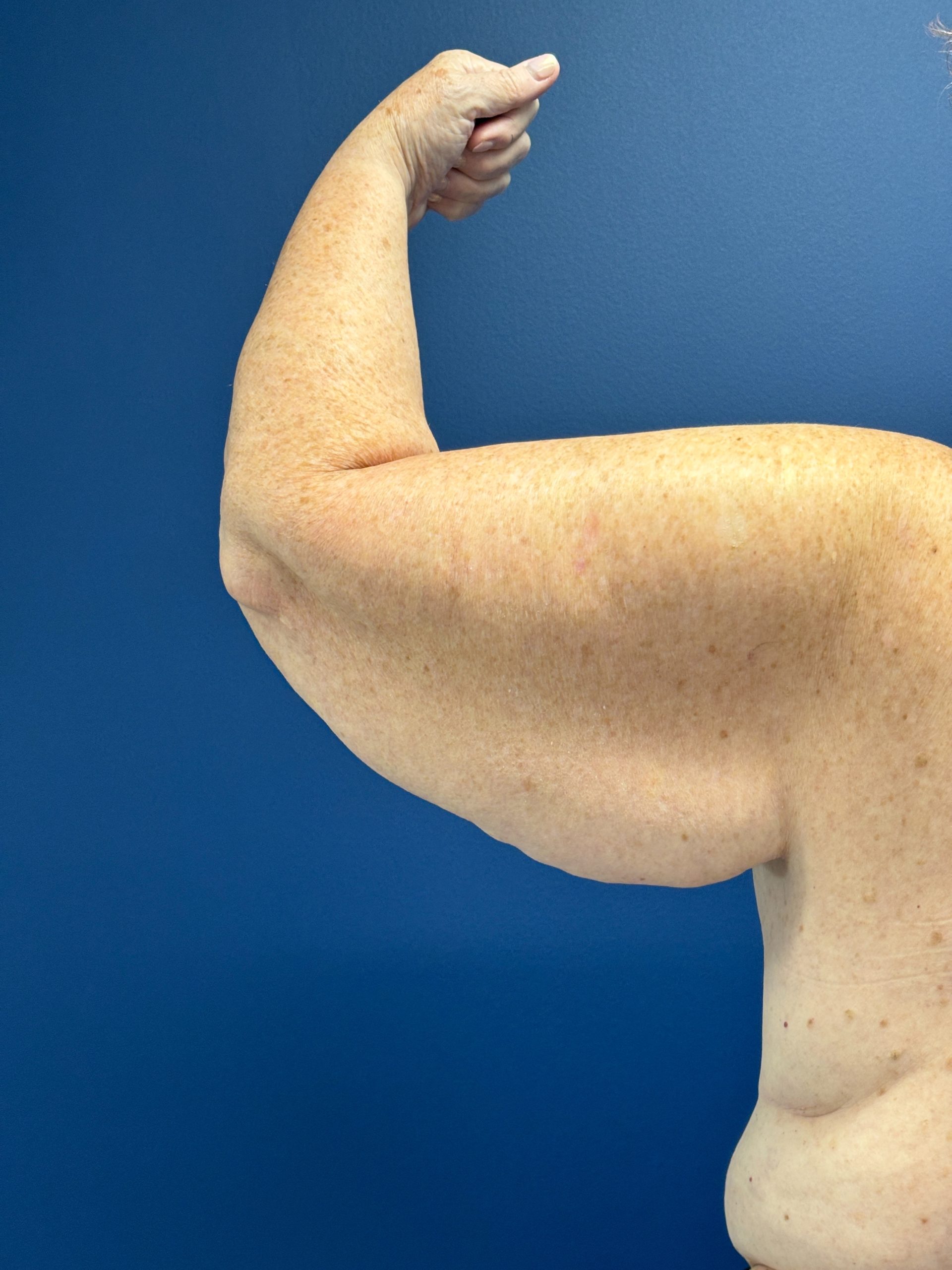 Brachioplasty-Case--3447 | Before Arm Lift 8