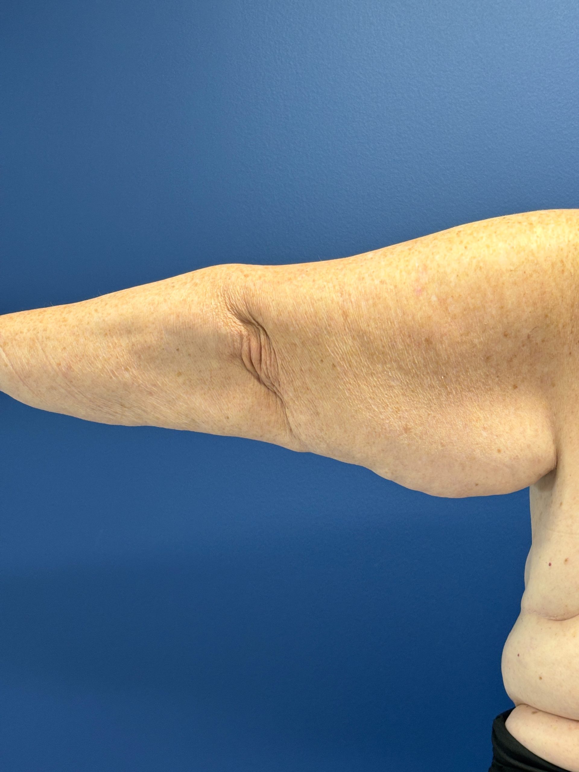 Brachioplasty-Case--3447 | Before Arm Lift 4