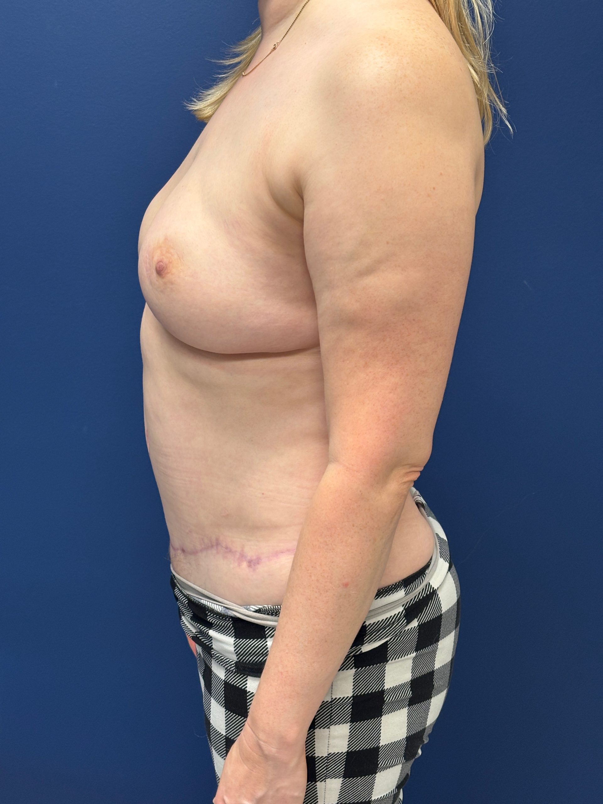 Lipoabdominoplasty-Case--3335 | After Liposuction 2