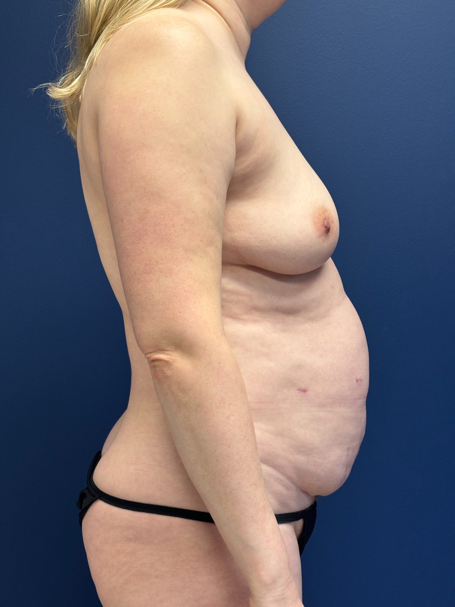 Lipoabdominoplasty-Case--3335 | Before Liposuction 3