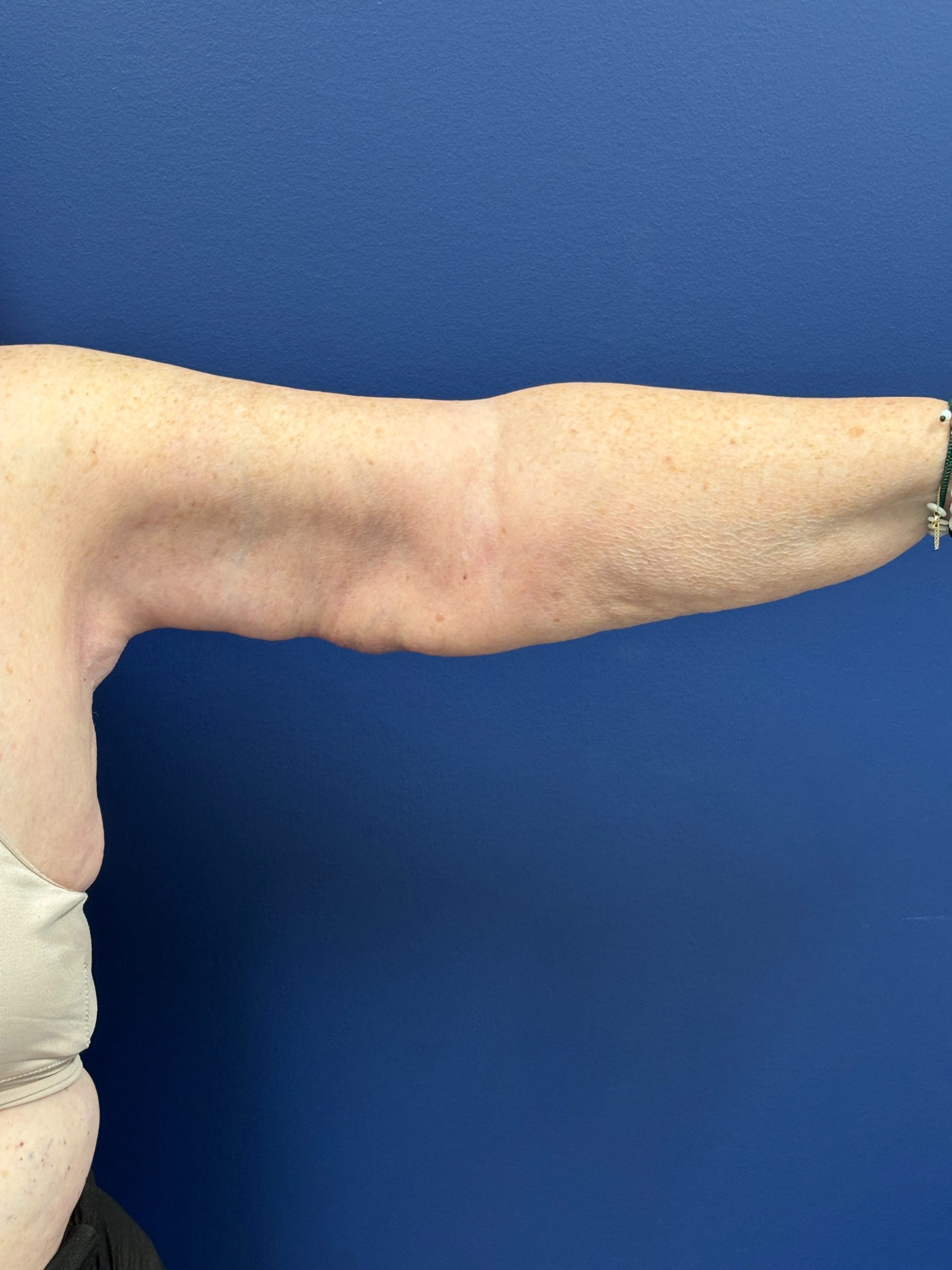 Brachioplasty-Case--3447 | After Arm Lift 1