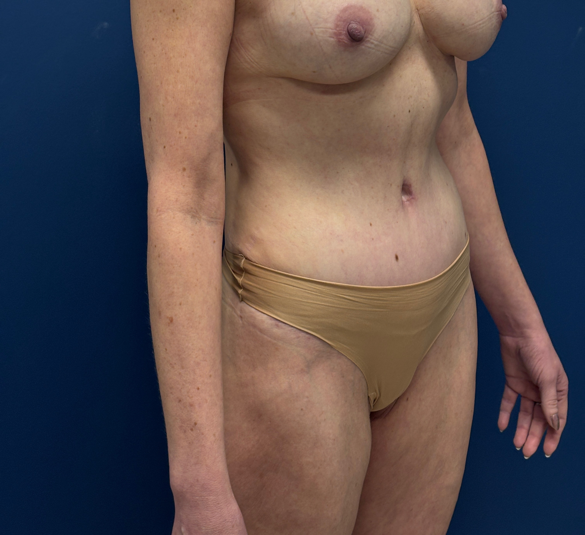 Liposuction-Case--3054 | After Liposuction 3