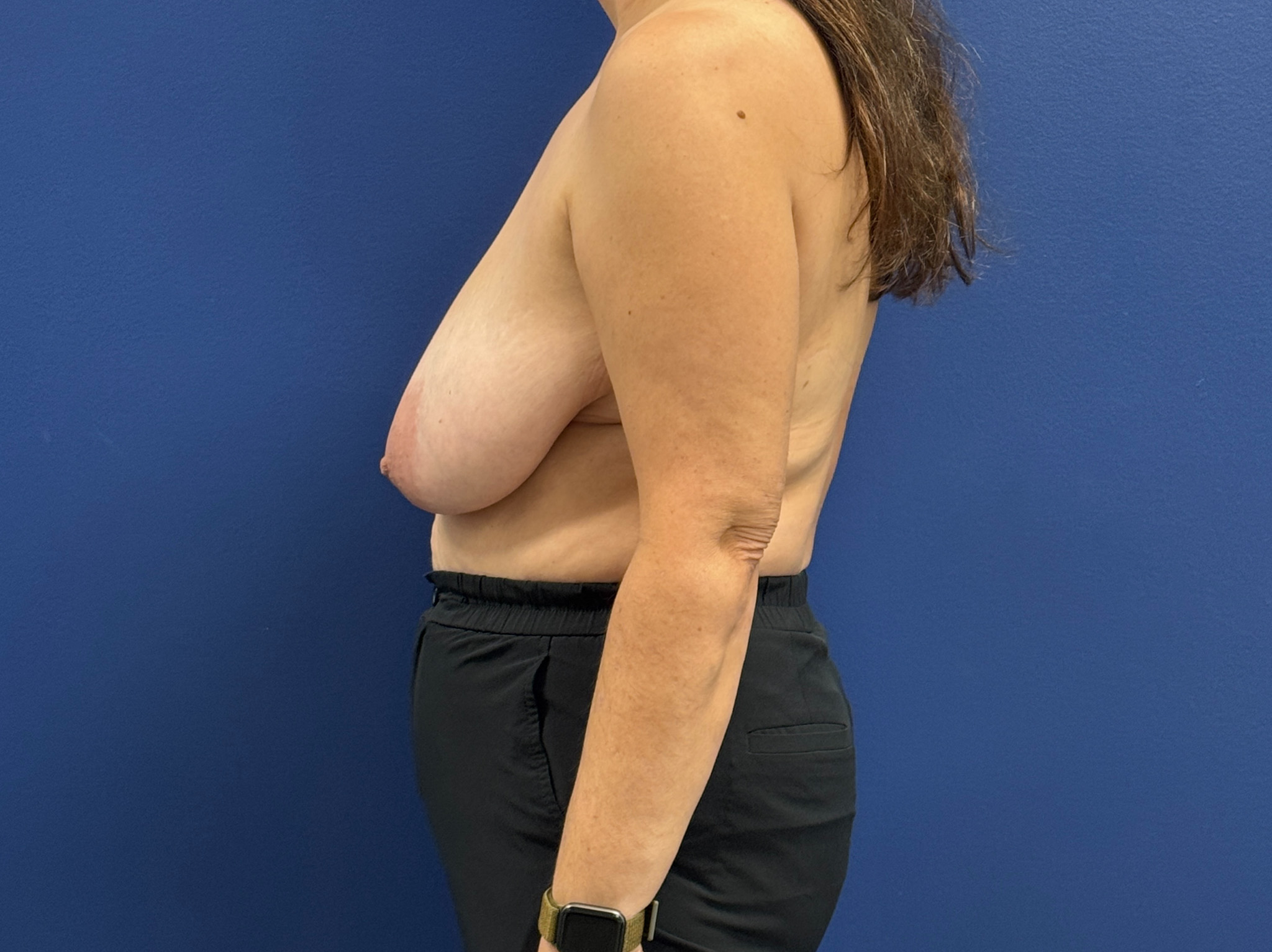 Breast-Reduction-Case--7709 | Before Breast Reduction 2