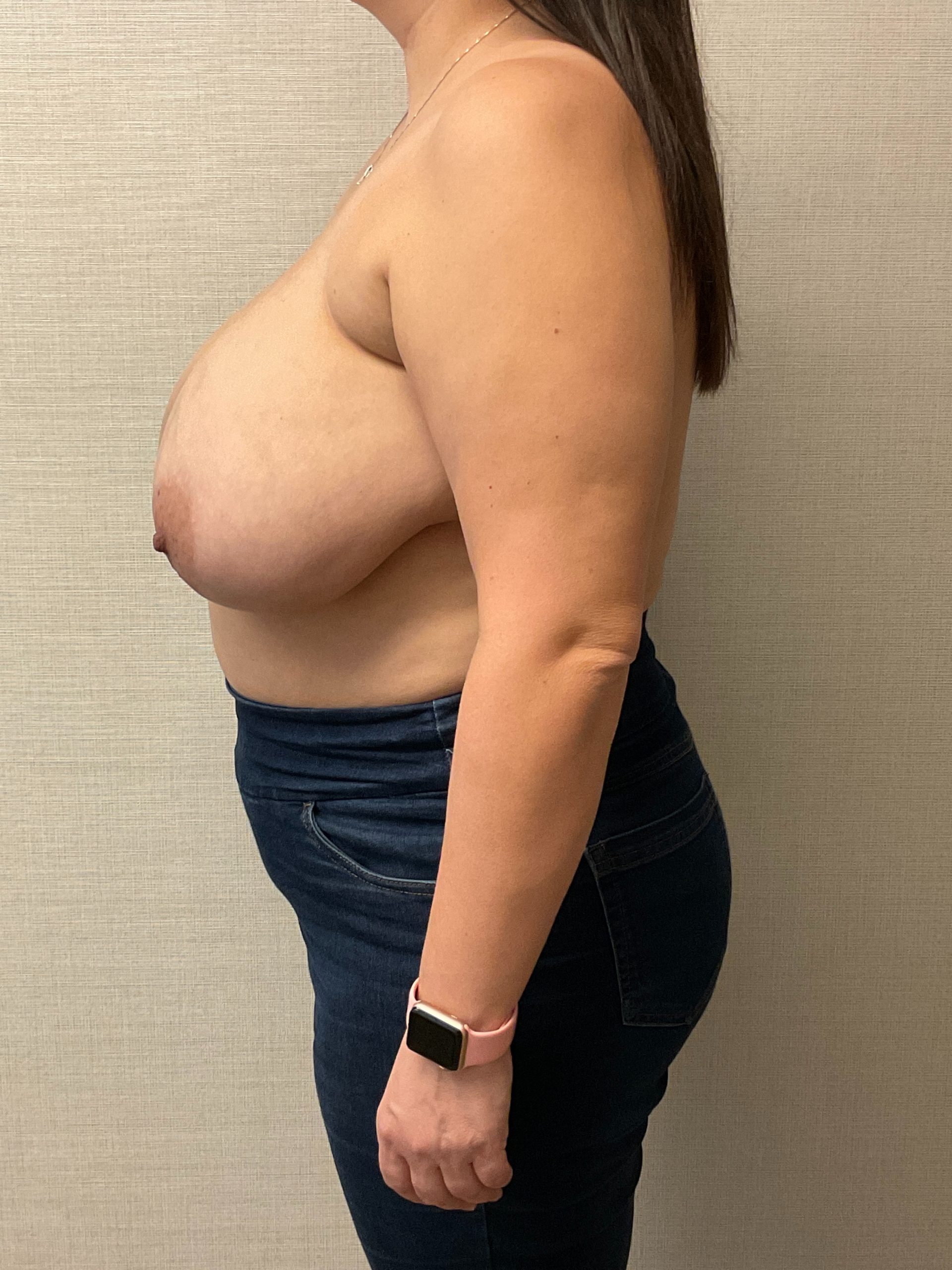 Breast-Reconstruction-Case--6507 | Before Breast Reconstruction 3