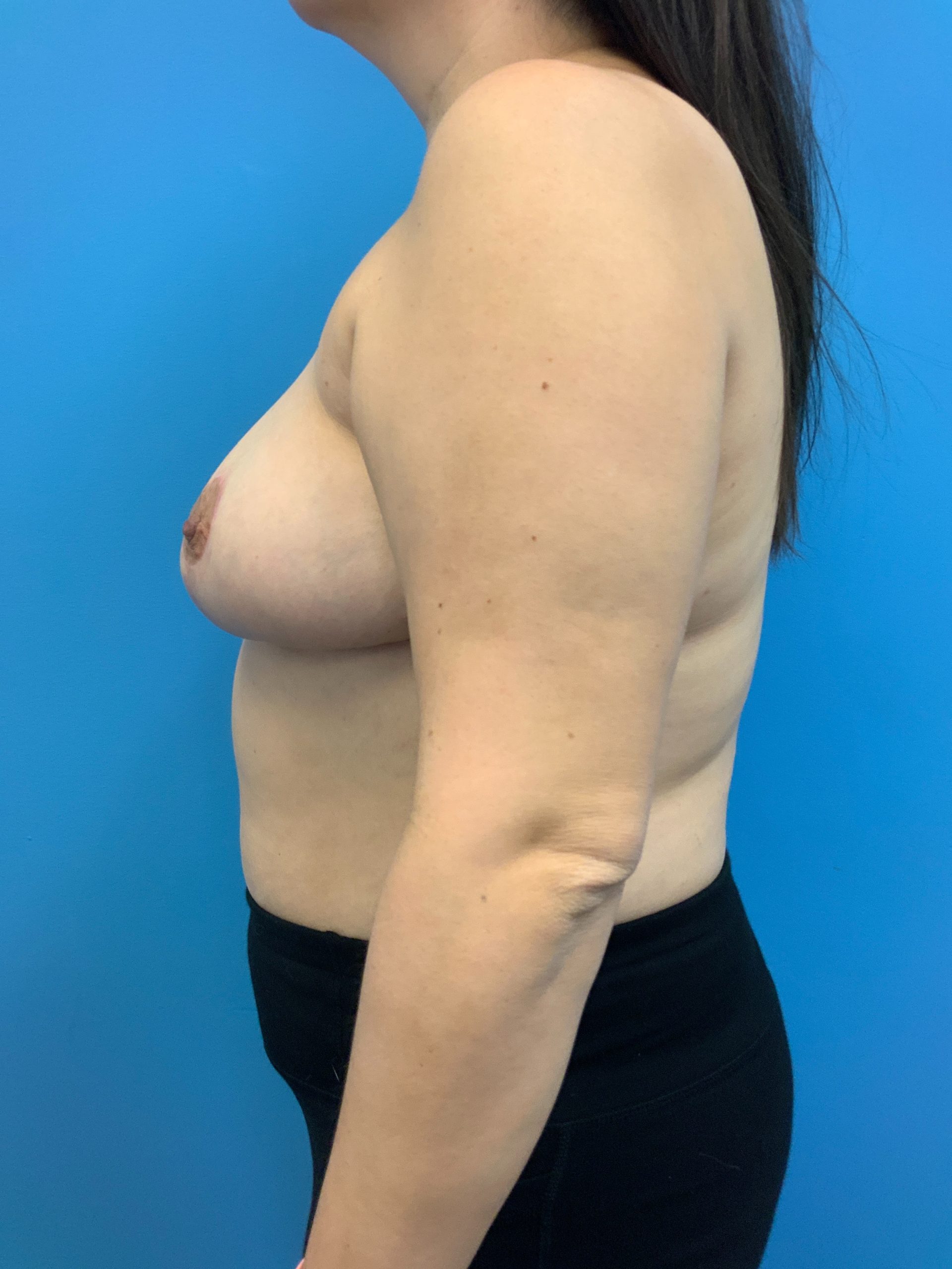 Breast-Reconstruction-Case--6507 | After Breast Reconstruction 3