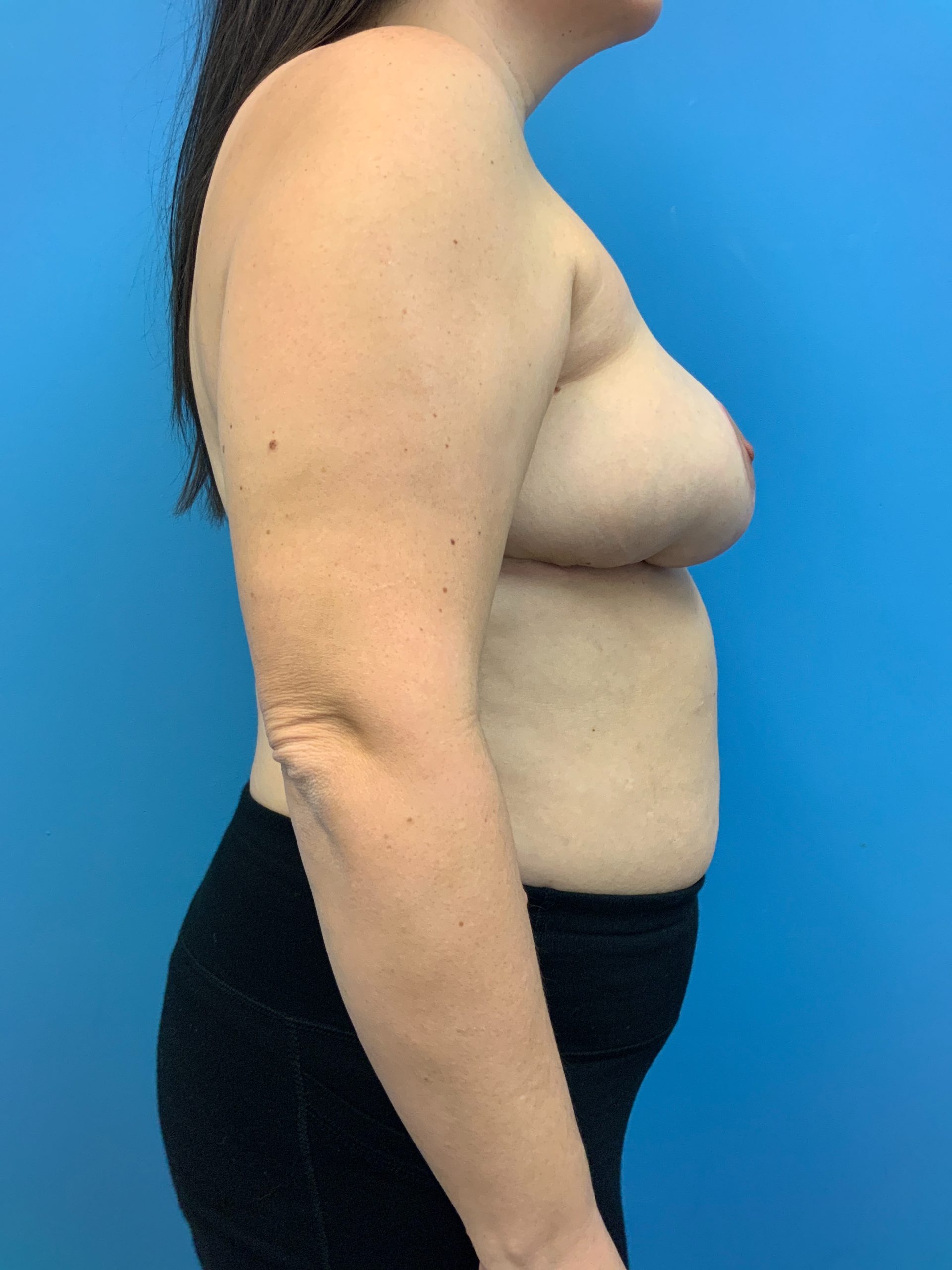 Breast-Reconstruction-Case--6507 | After Breast Reconstruction 2
