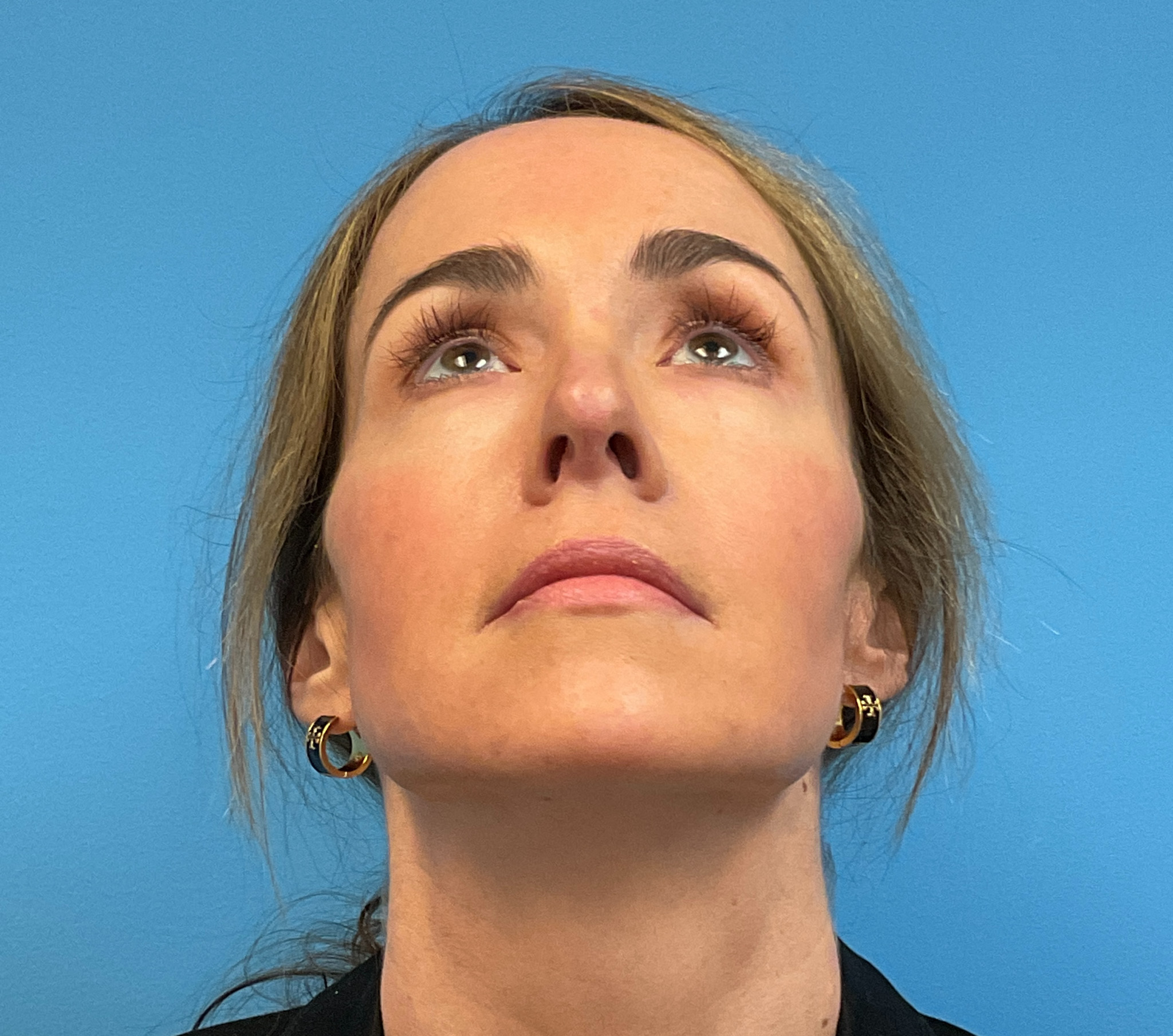 Rhinoplasty-Case--1281 | After Rhinoplasty 2