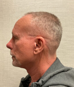 Rhinoplasty-Case--3129 | After Rhinoplasty for Men 2