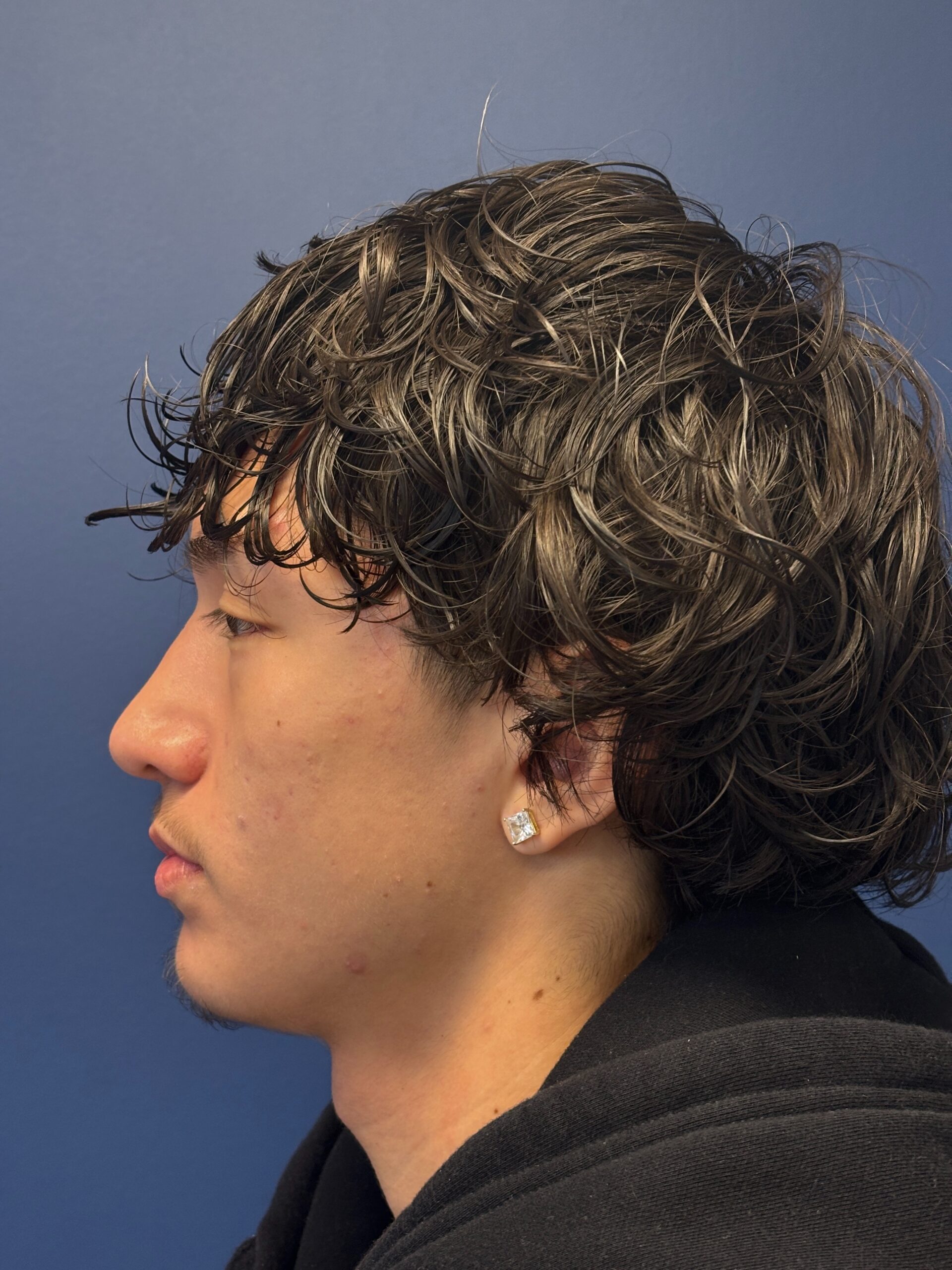 Rhinoplasty-Case--2339 | After Rhinoplasty 3