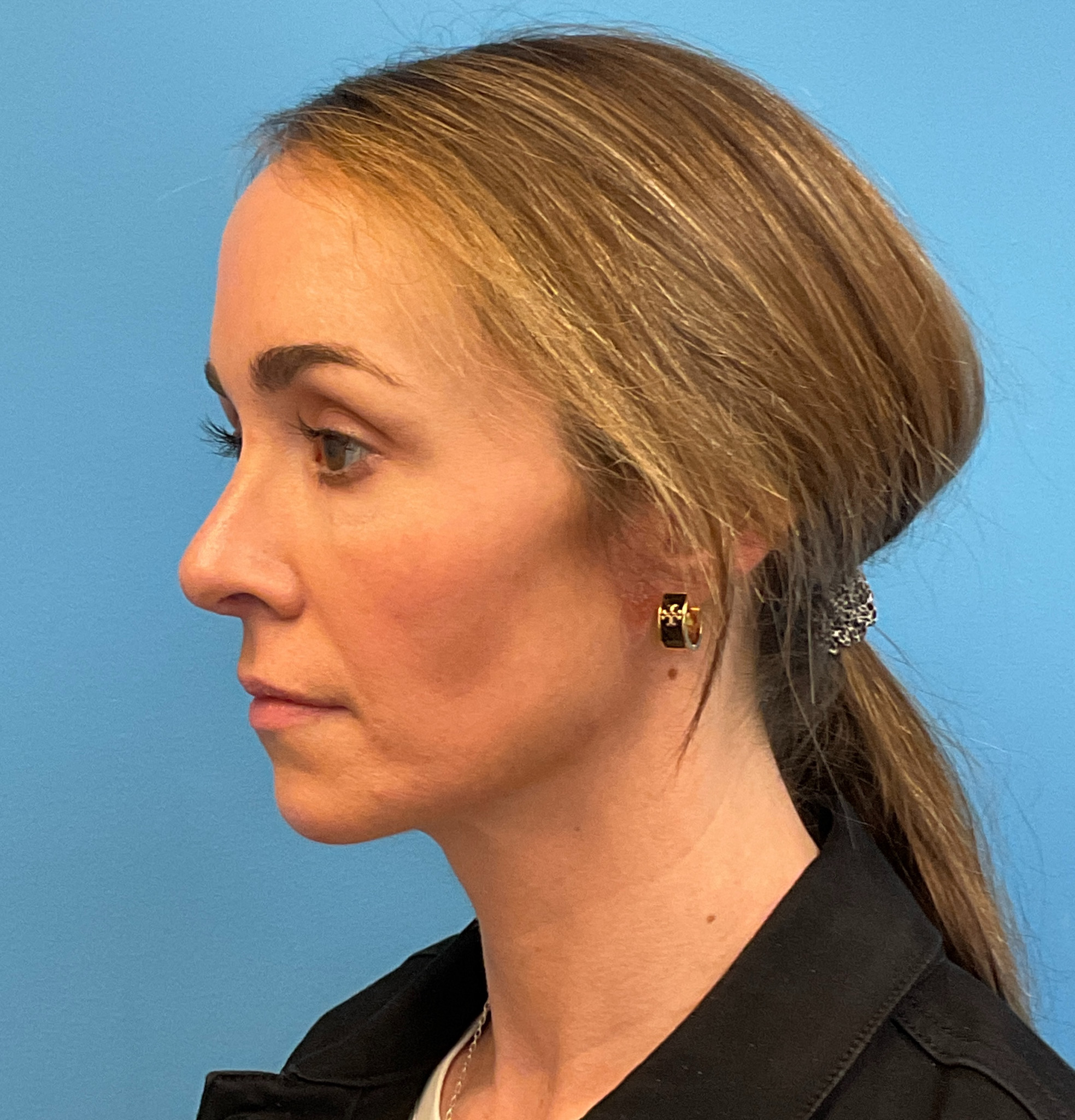 Rhinoplasty-Case--1281 | After Rhinoplasty 5
