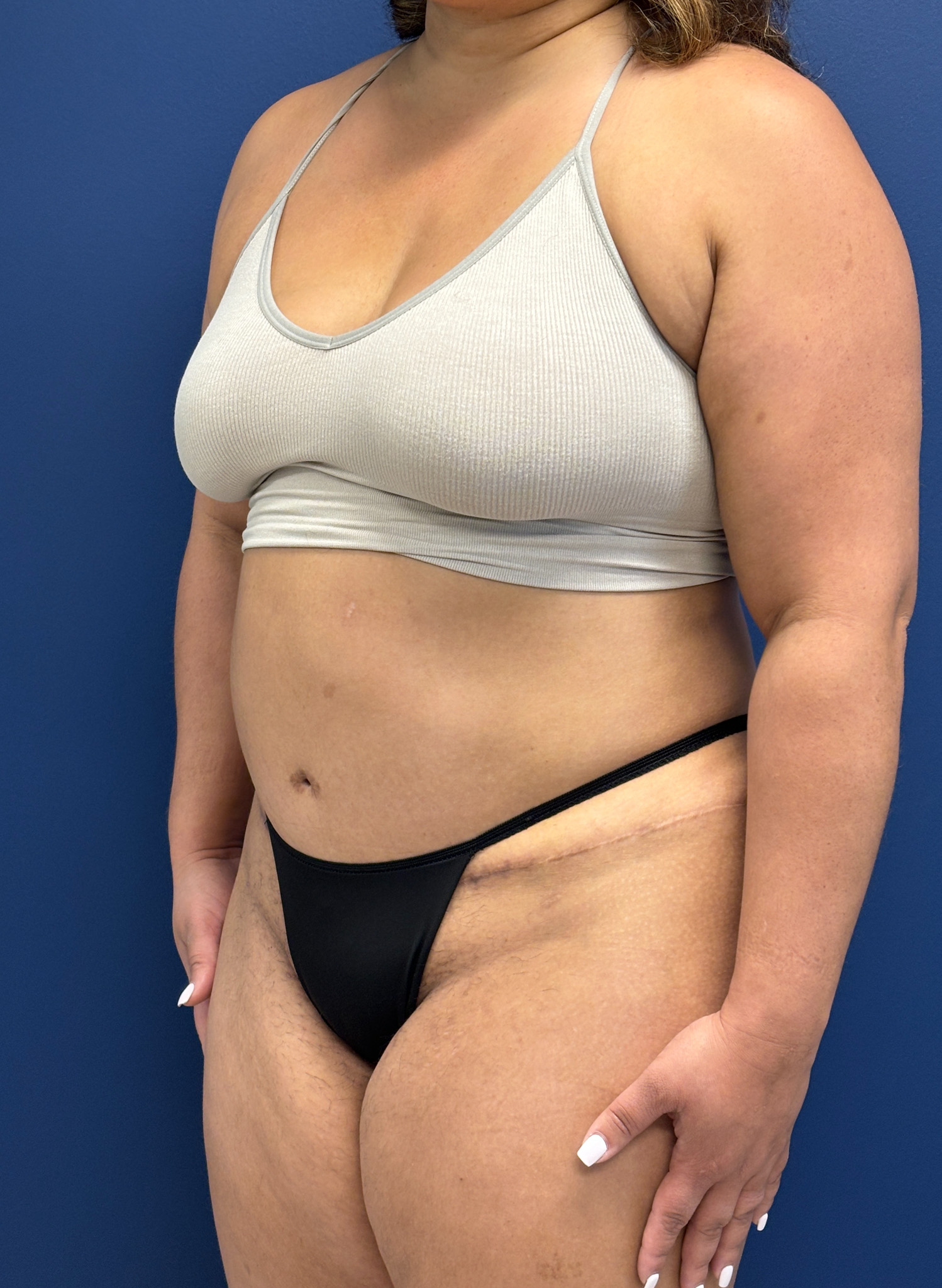 Abdominoplasty-Case--9870 | After Tummy Tuck 5