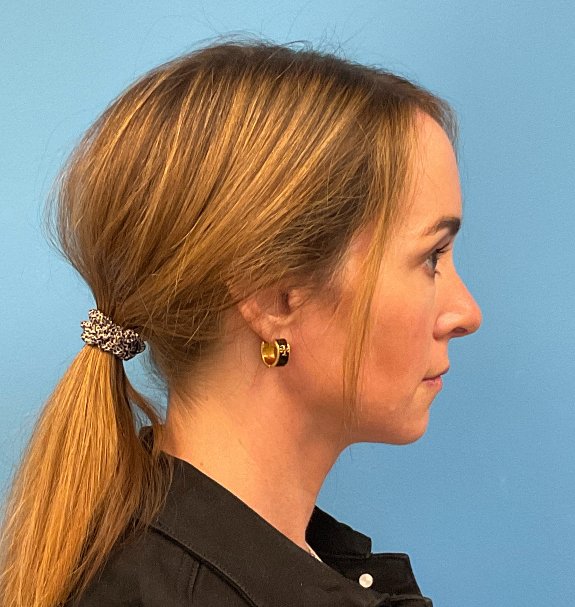 Rhinoplasty-Case--1281 | After Rhinoplasty 4