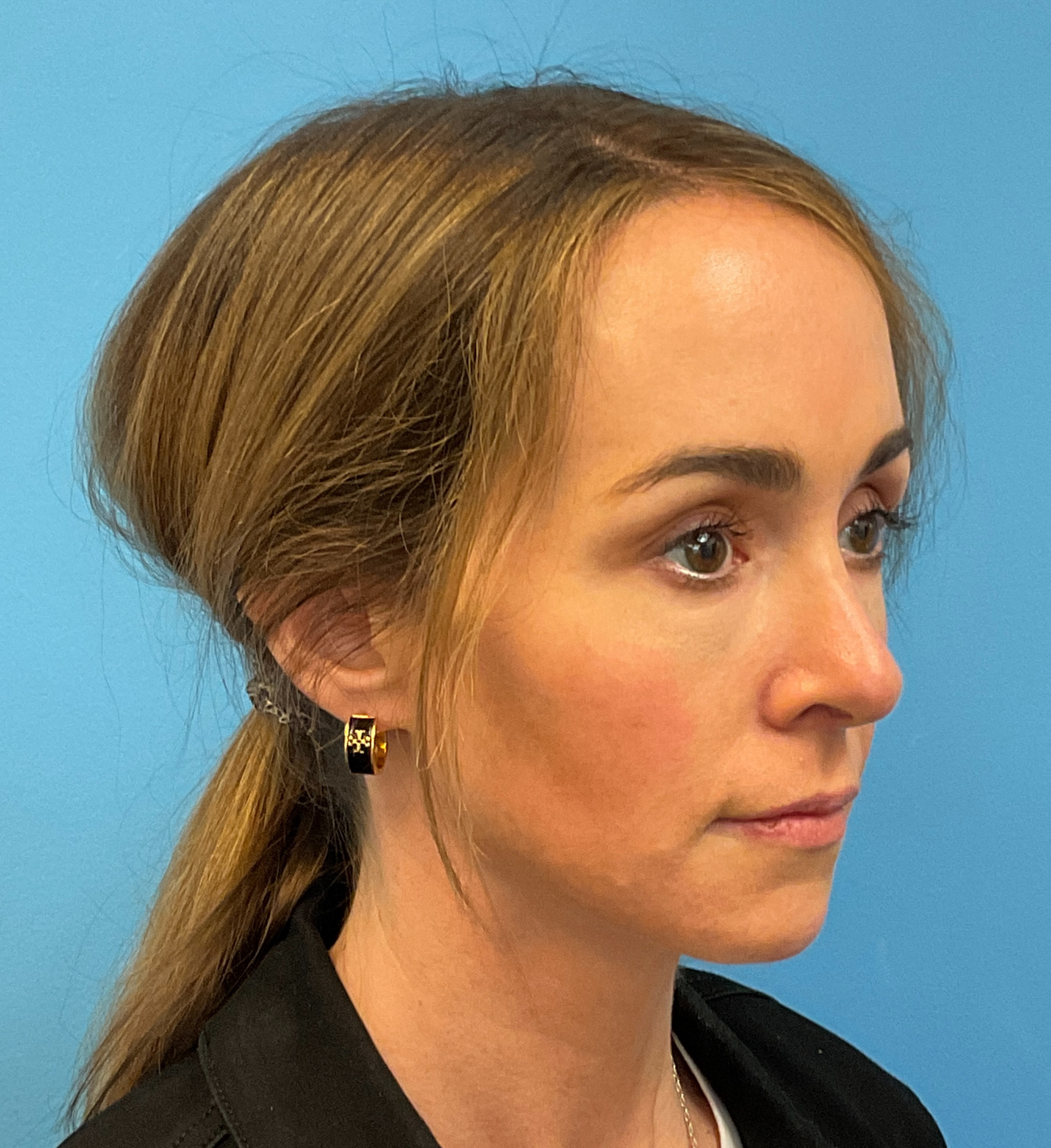 Rhinoplasty-Case--1281 | After Rhinoplasty 6
