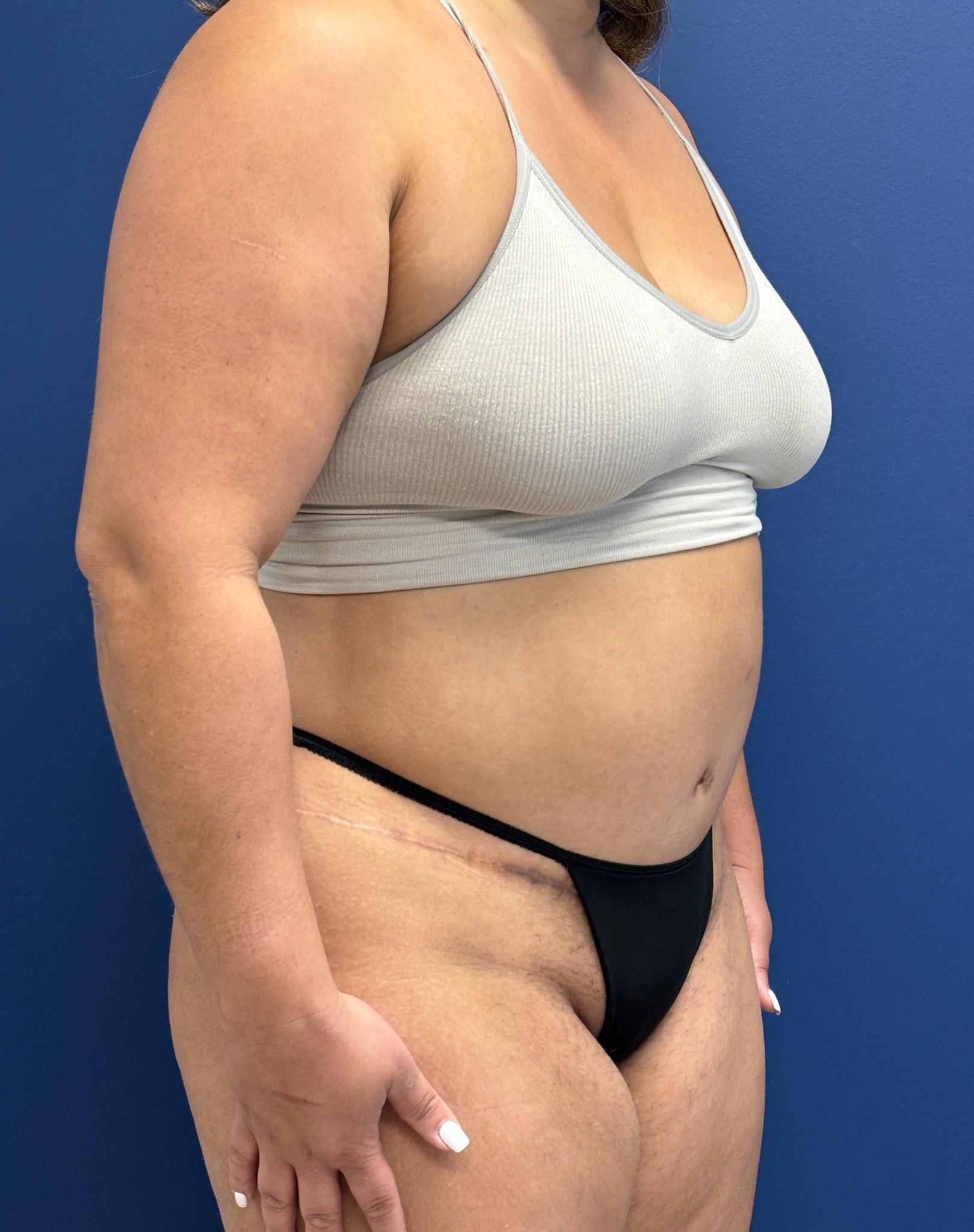 Abdominoplasty-Case--9870 | After Tummy Tuck 4