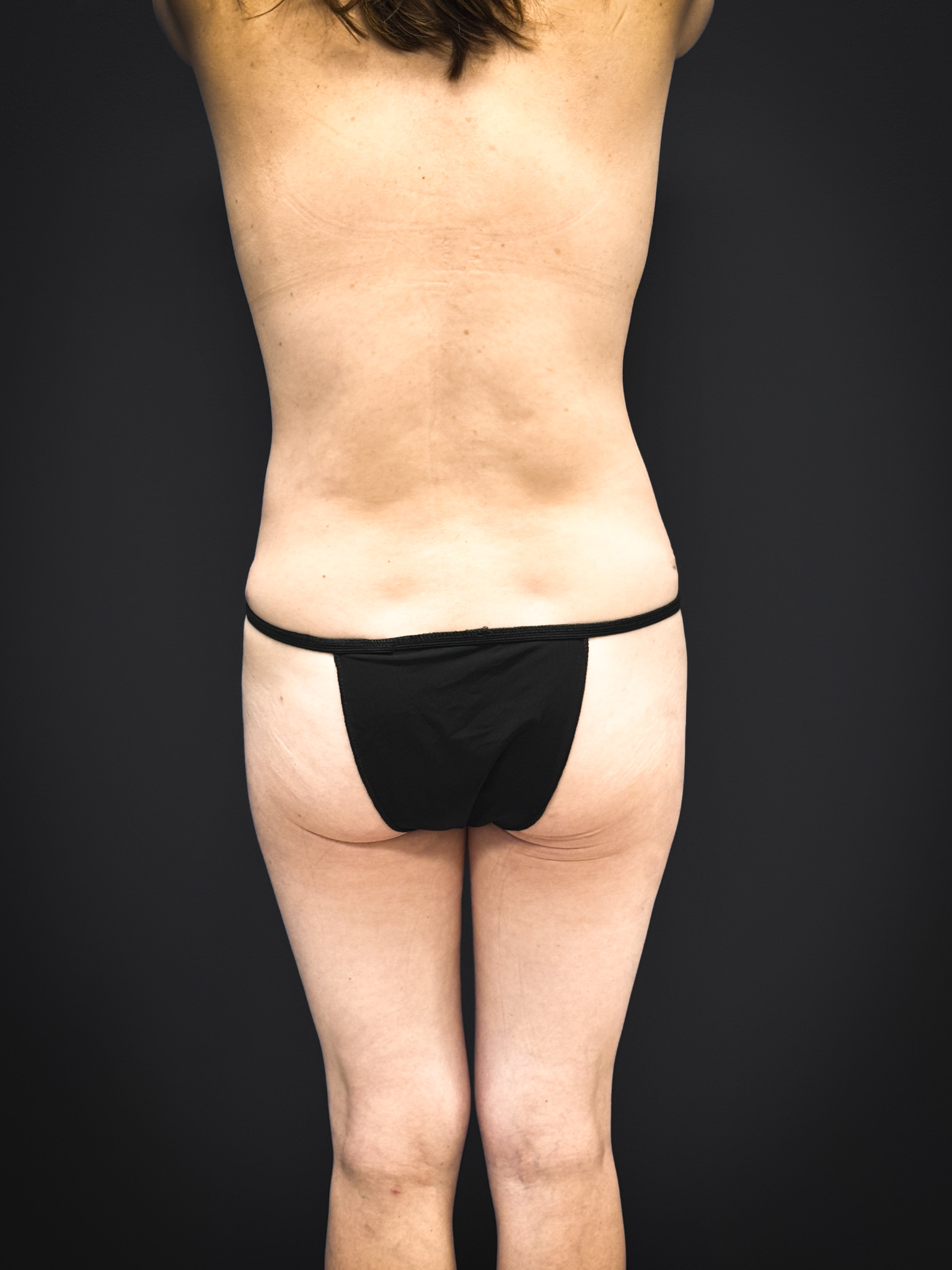 Tummy-Tuck-Case--5969 | After Tummy Tuck 6