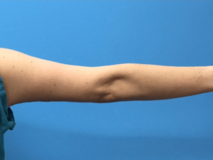 Brachioplasty-Case--276 | After Arm Lift 2