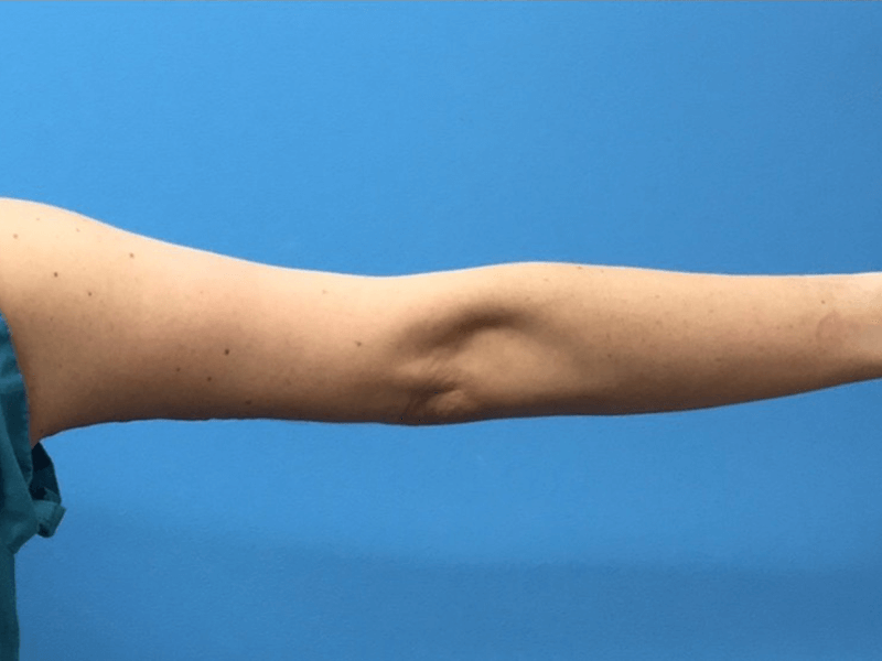 Brachioplasty-Case--276 | After Arm Lift 2