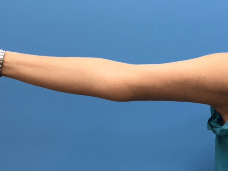 Brachioplasty-Case--276 | After Arm Lift 3