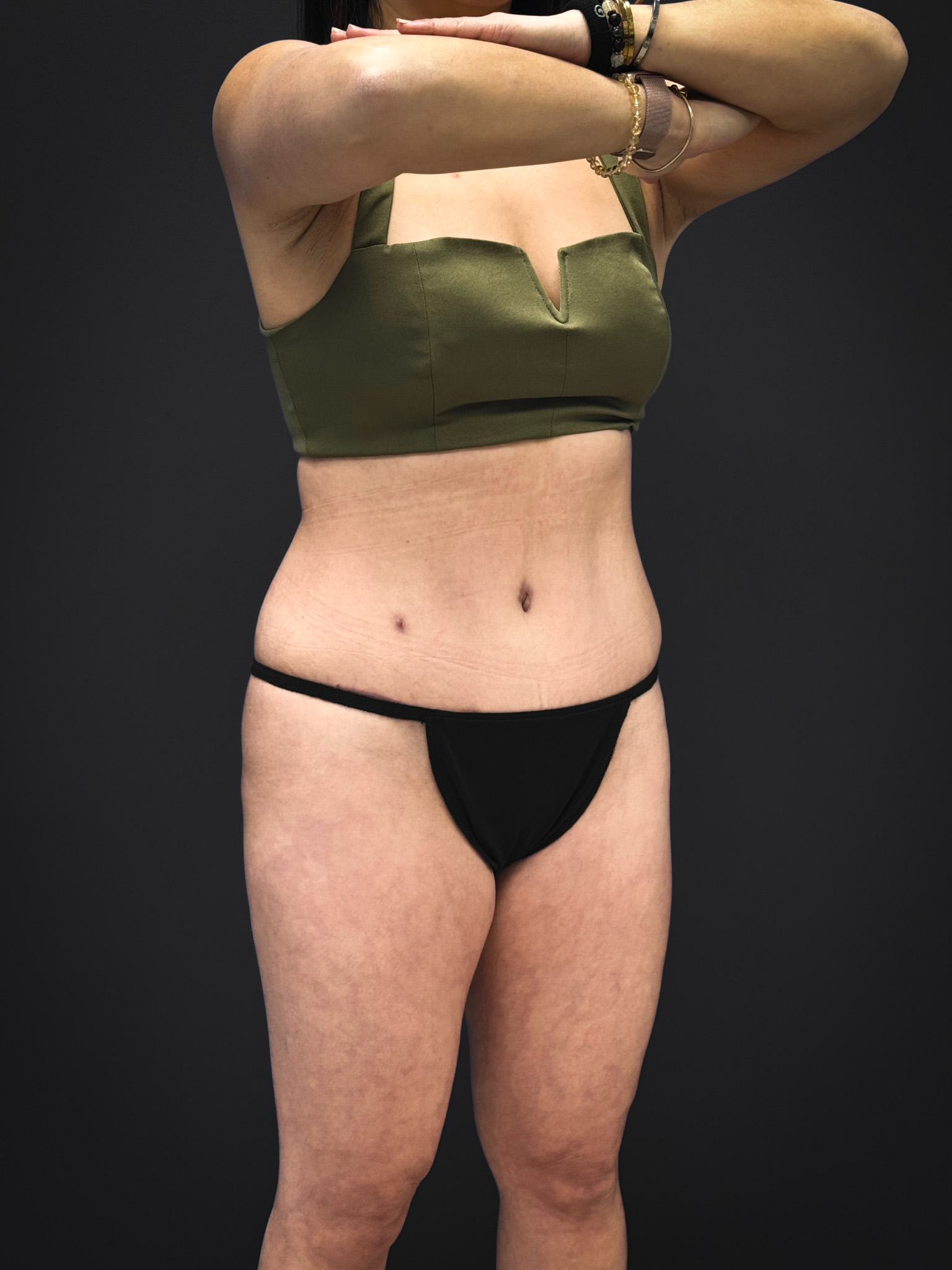 Tummy-Tuck-Case--3757 | After Tummy Tuck 3